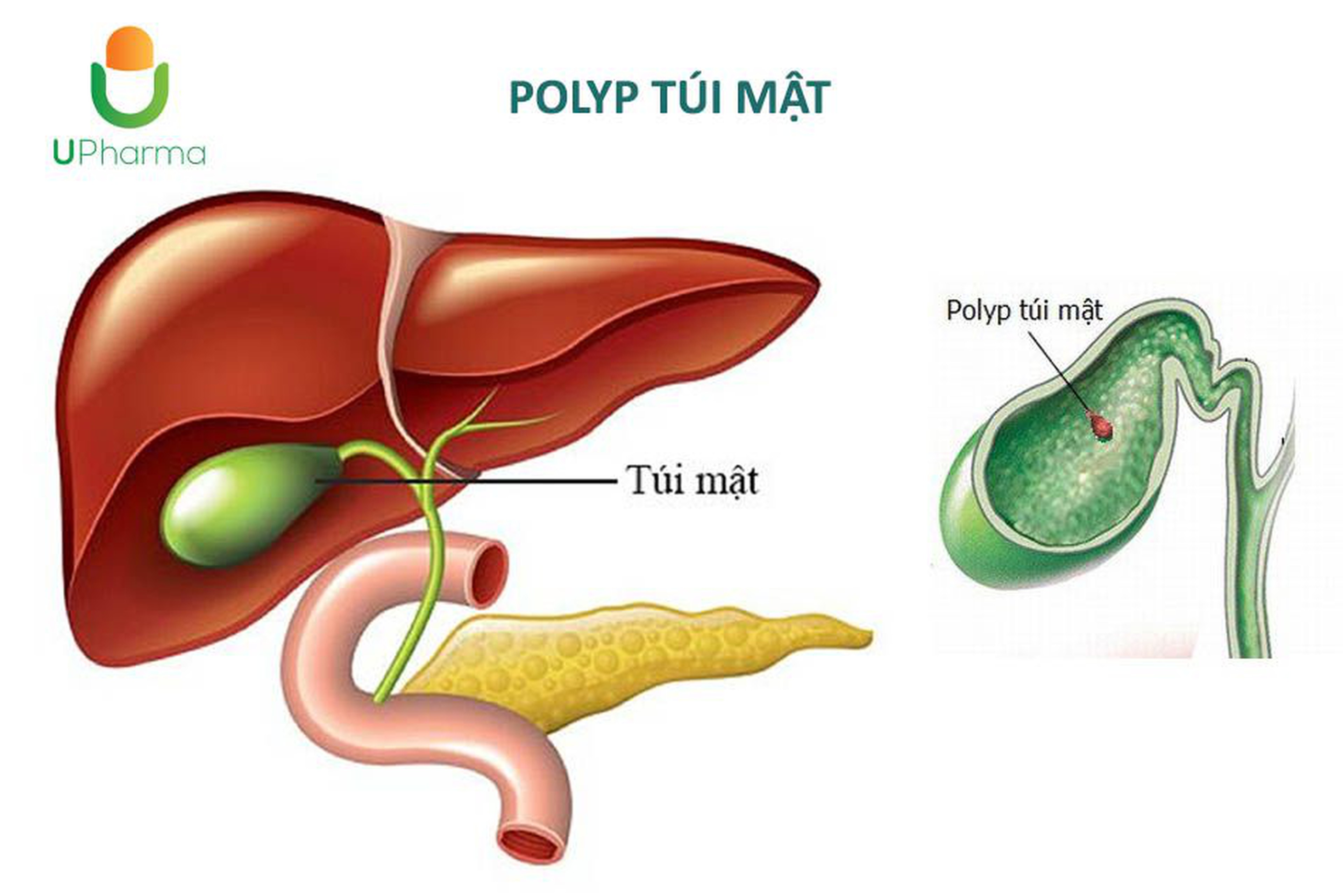 Polyp túi mật? Nguyên nhân, triệu chứng, chẩn đoán và điều trị.
