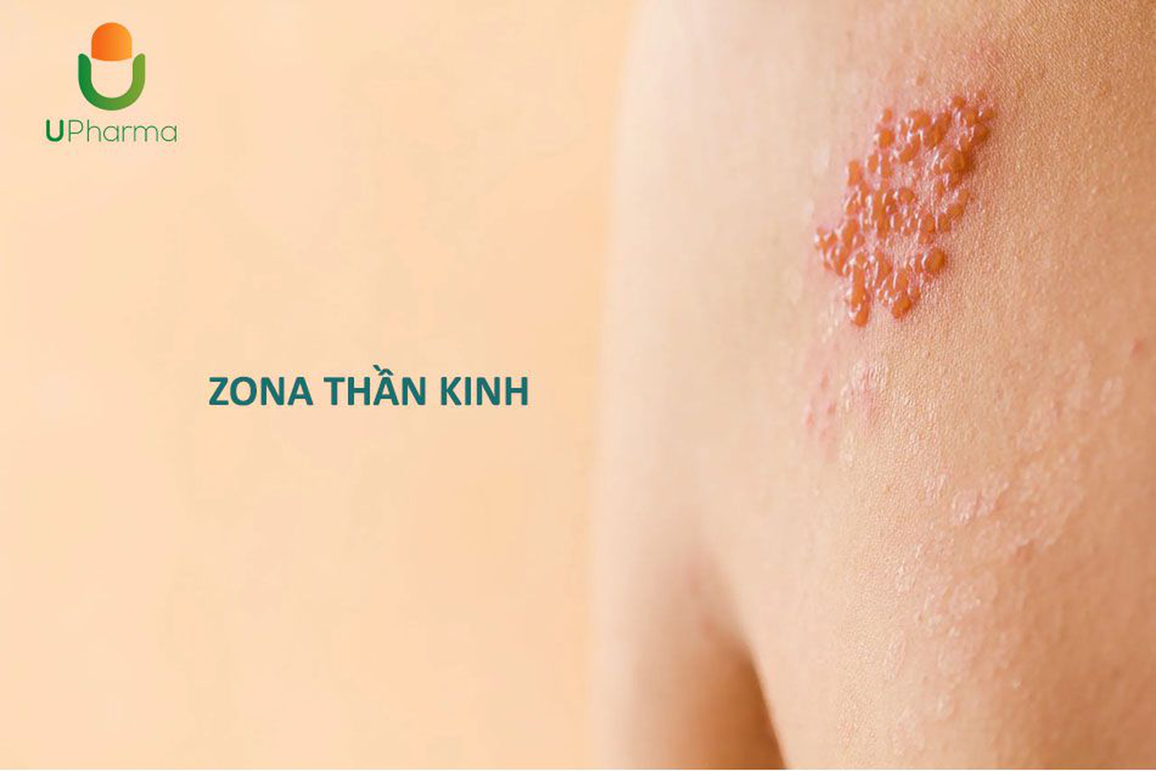 Bệnh Zona thân kinh và những điều cần biết?
