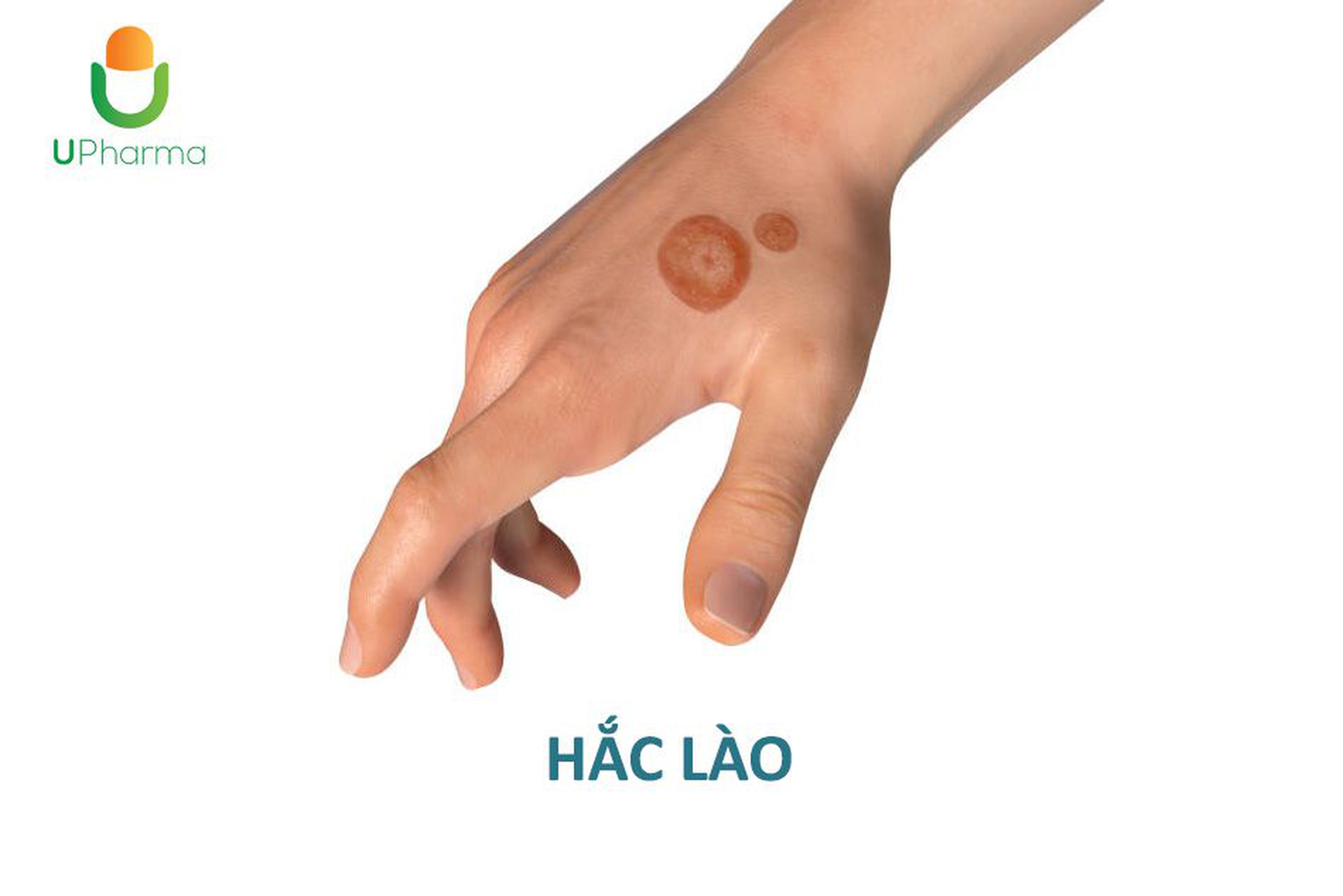 Hắc lào- Nguyên nhân, triệu chứng, đối tượng và phương pháp điều trị.