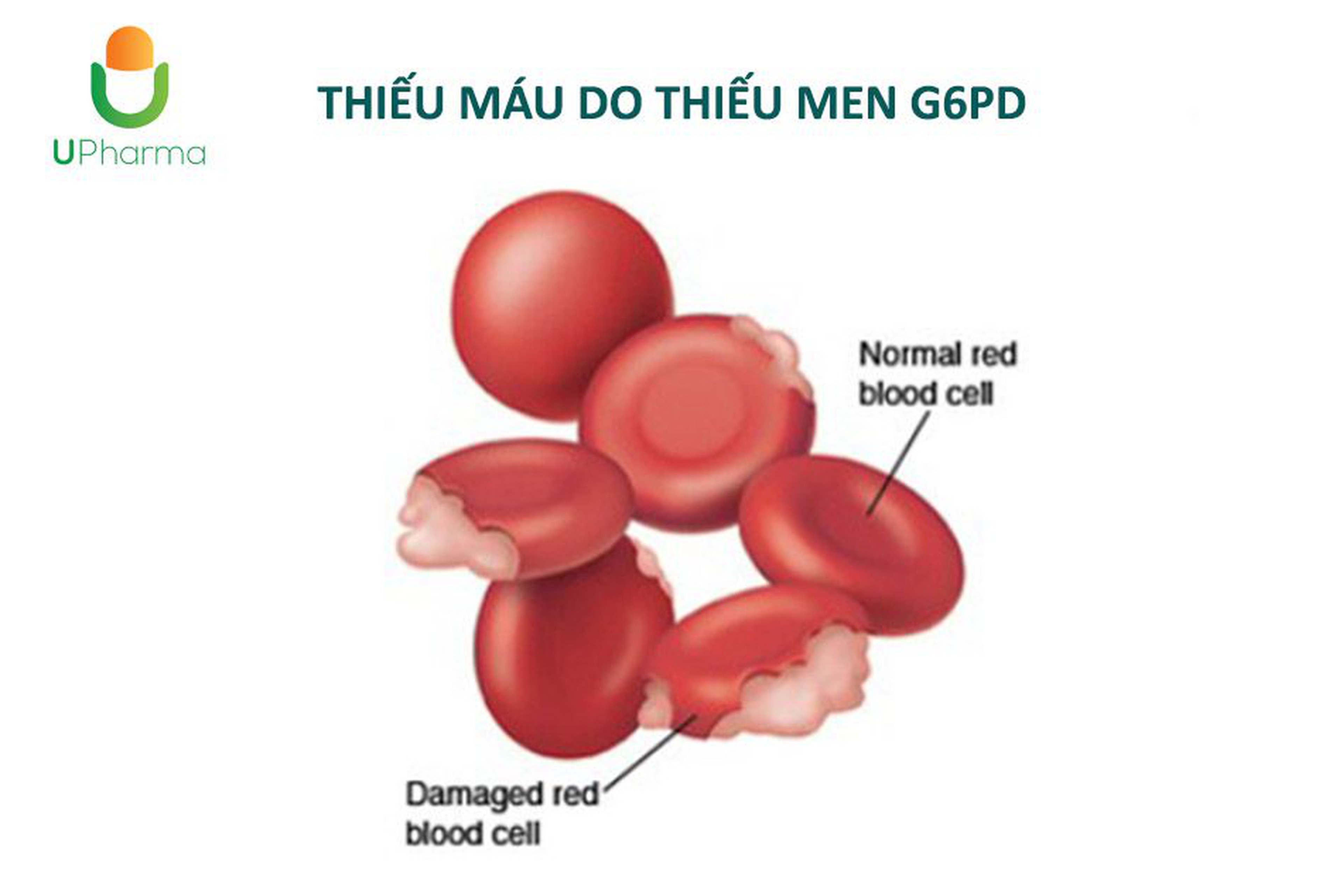 Thiếu máu do thiếu men G6PD là gì? Nguyên nhân, triệu chứng, chẩn đoán và điều trị bệnh.