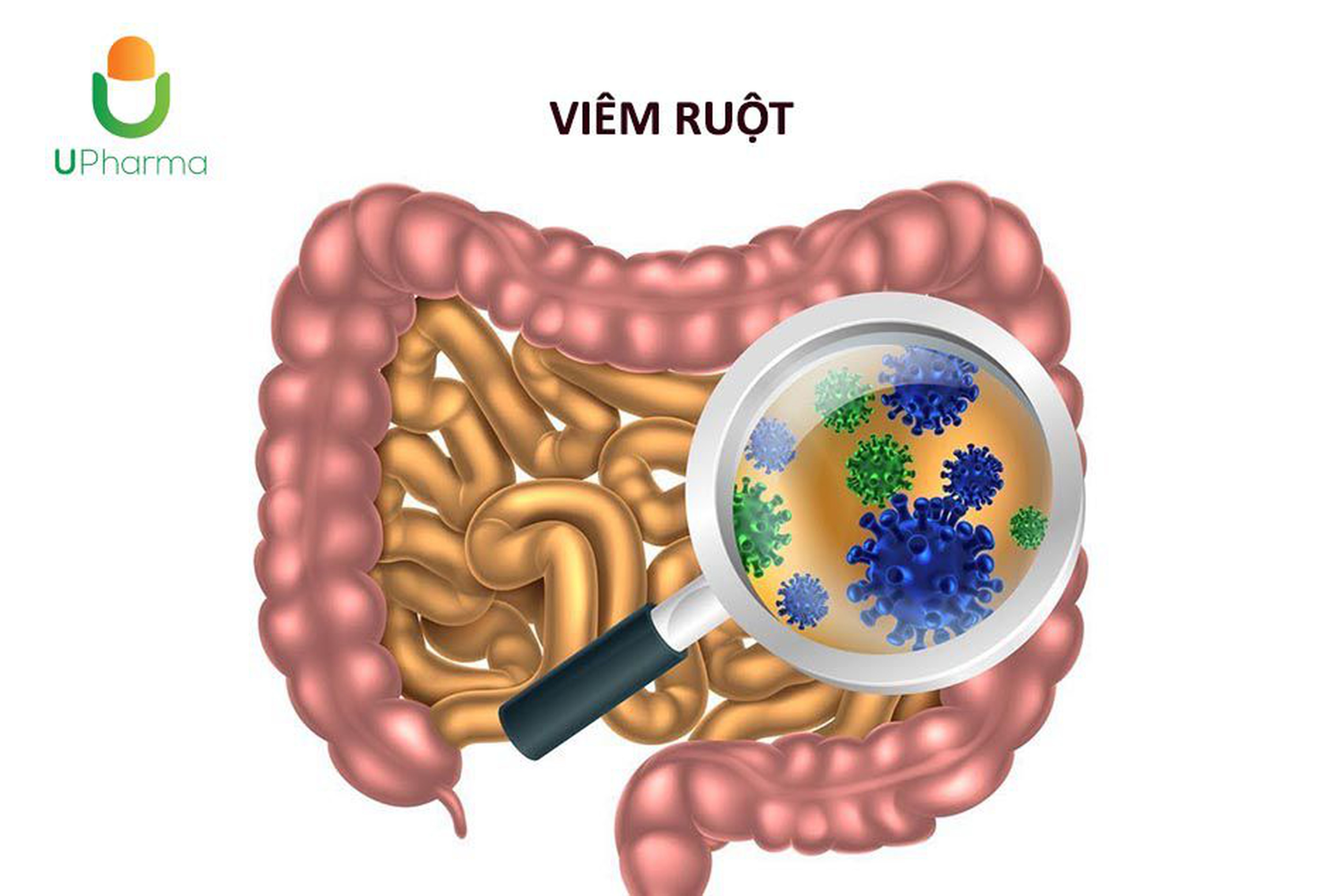 Viêm ruột: Nguyên nhân, triệu chứng, biến chứng và cách điều trị bệnh.
