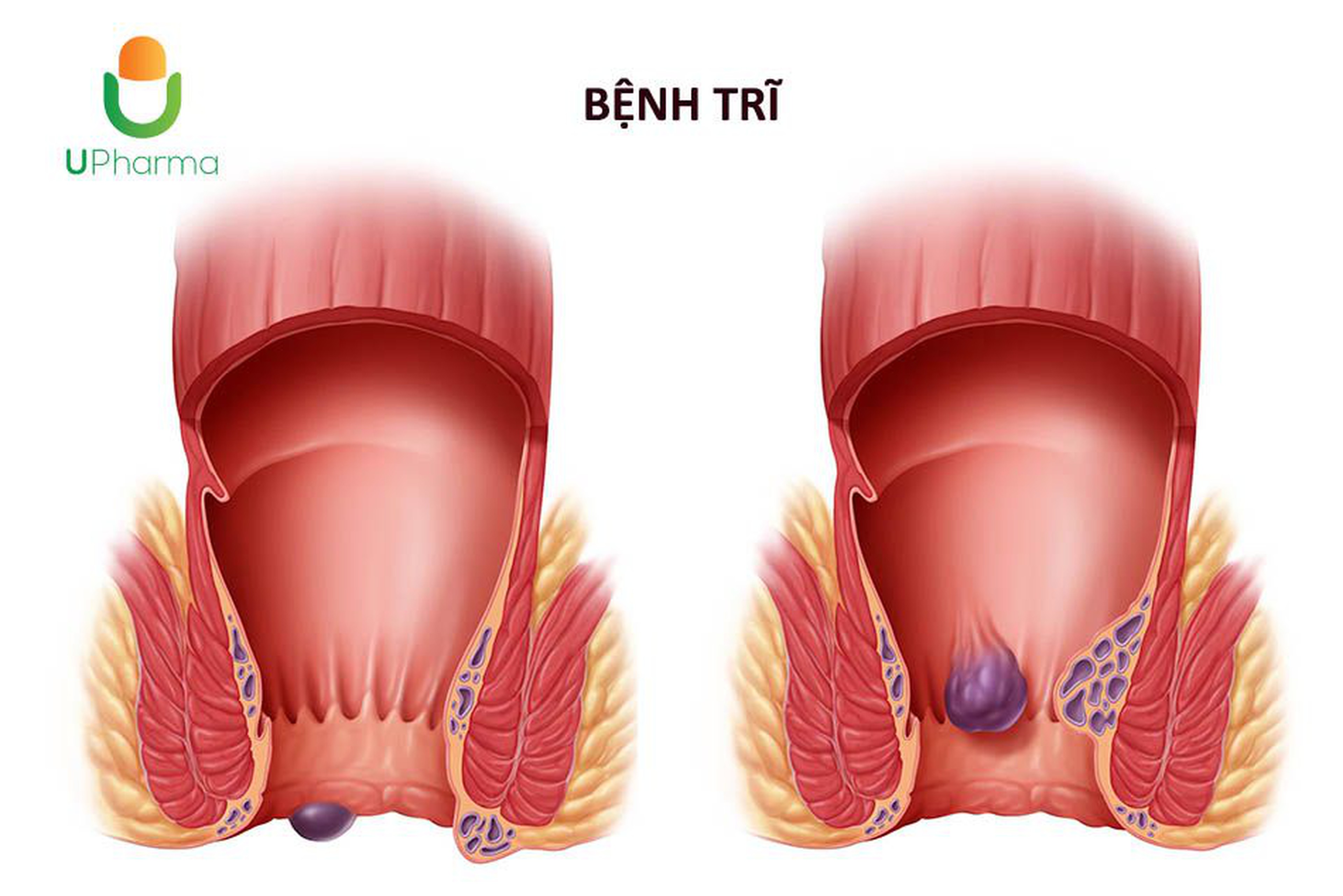 Trĩ - Nguyên nhân, triệu chứng, đối tượng và phương pháp điều trị.
