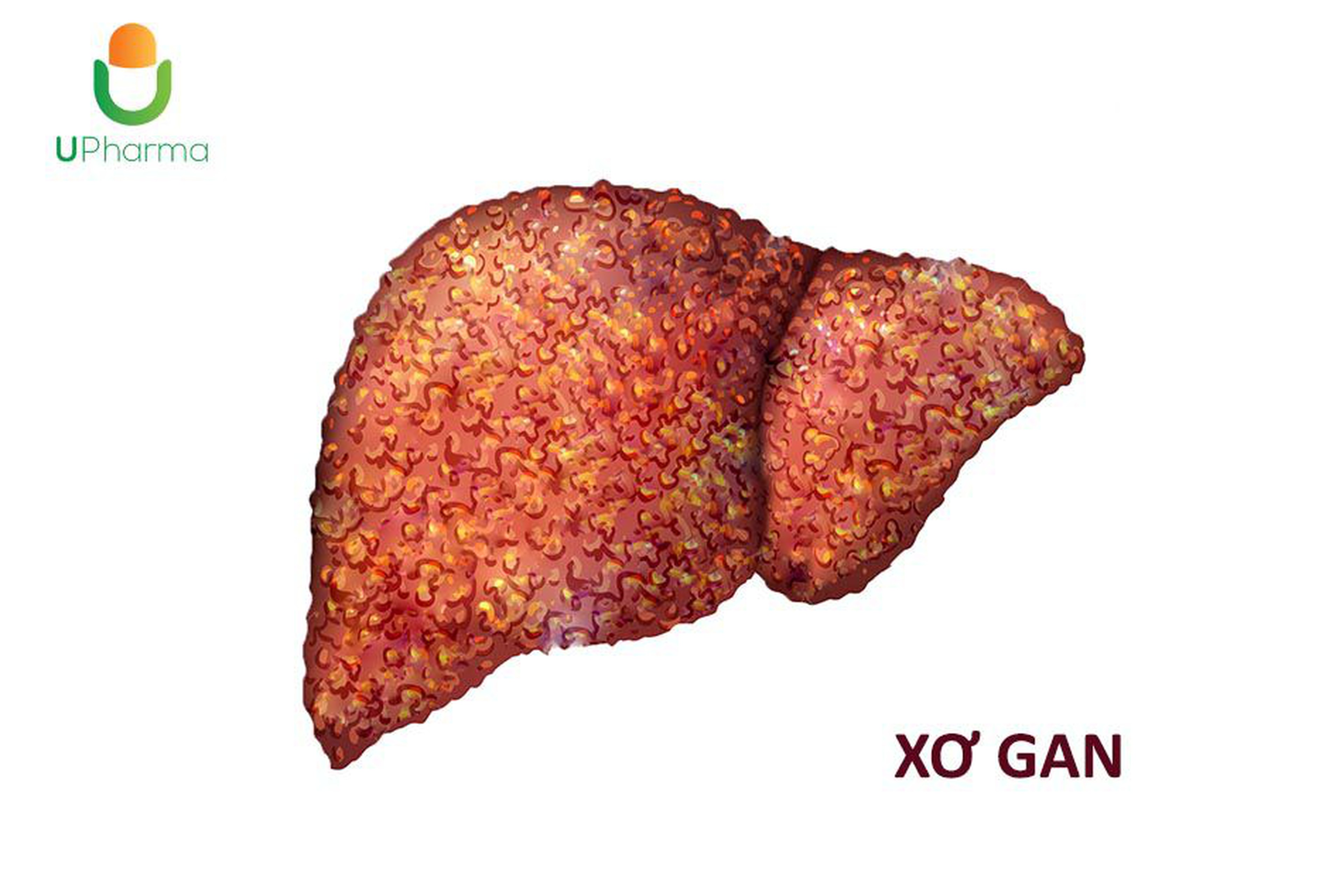 Xơ gan: Nguyên nhân, triệu chứng, chẩn đoán và điều trị