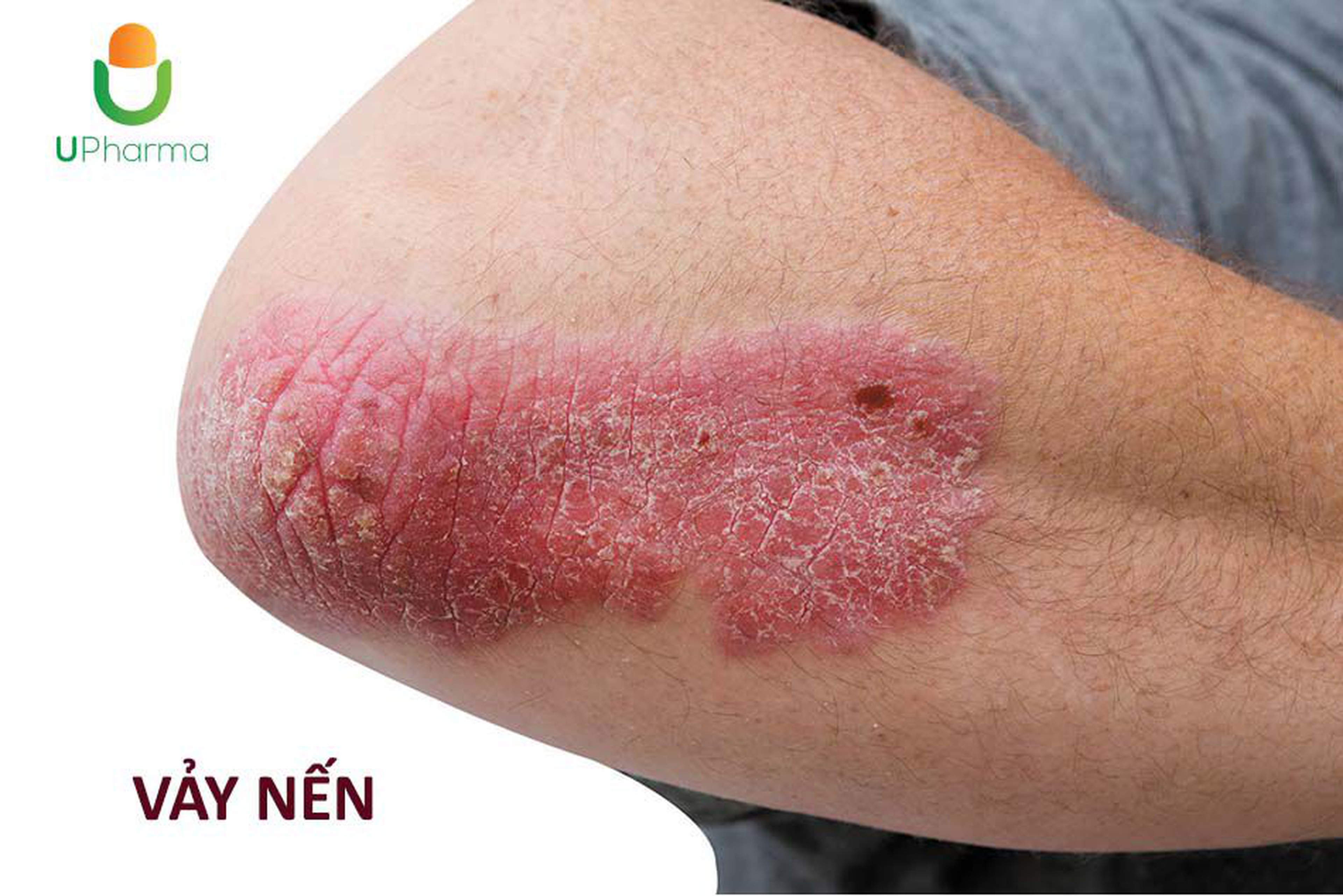 Bệnh vảy nến là gì? Nguyên nhân, triệu chứng, cách điều trị.