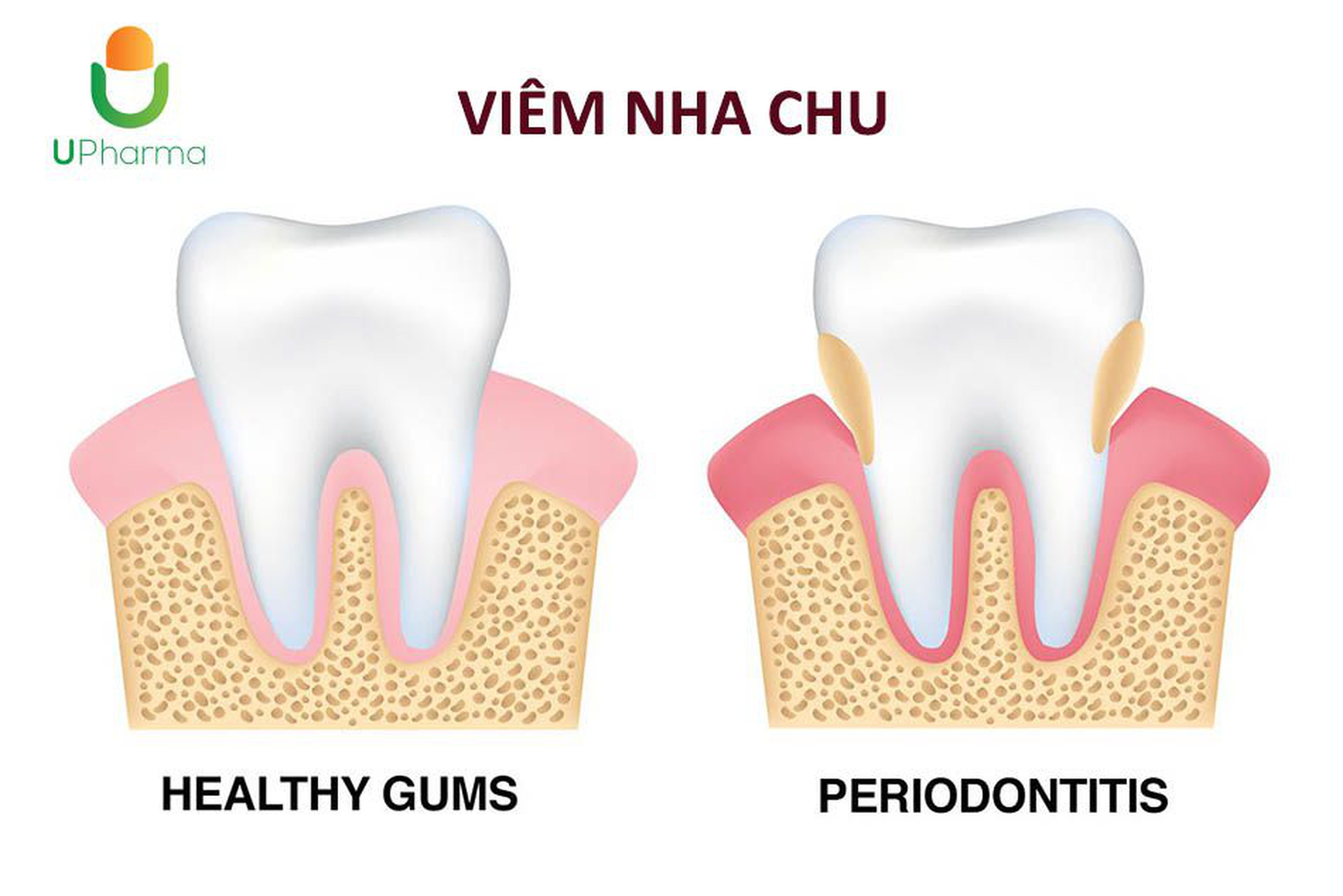 Viêm nha chu là gì? Nguyên nhân dẫn đến viêm nha chu, dấu hiệu, biện pháp phòng và điều trị bệnh.