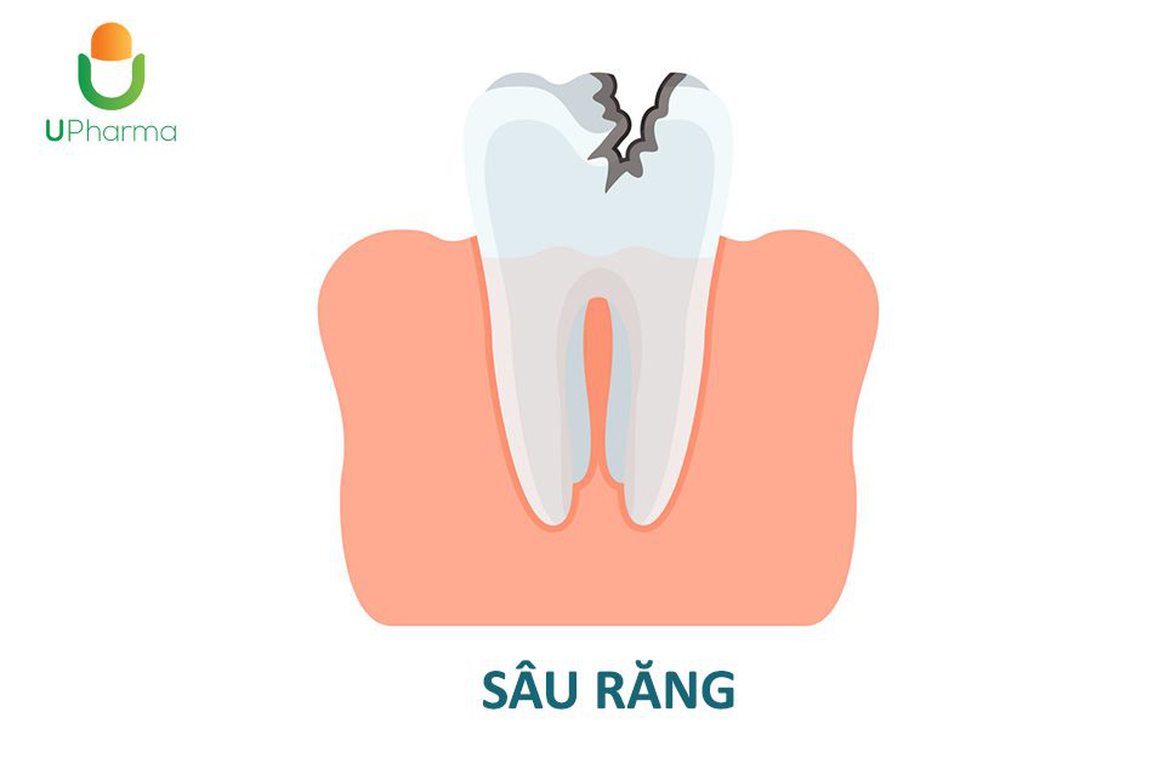 Sâu răng: Nguyên nhân gây ra sâu răng, triệu chứng, cách điều trị và phòng ngừa.