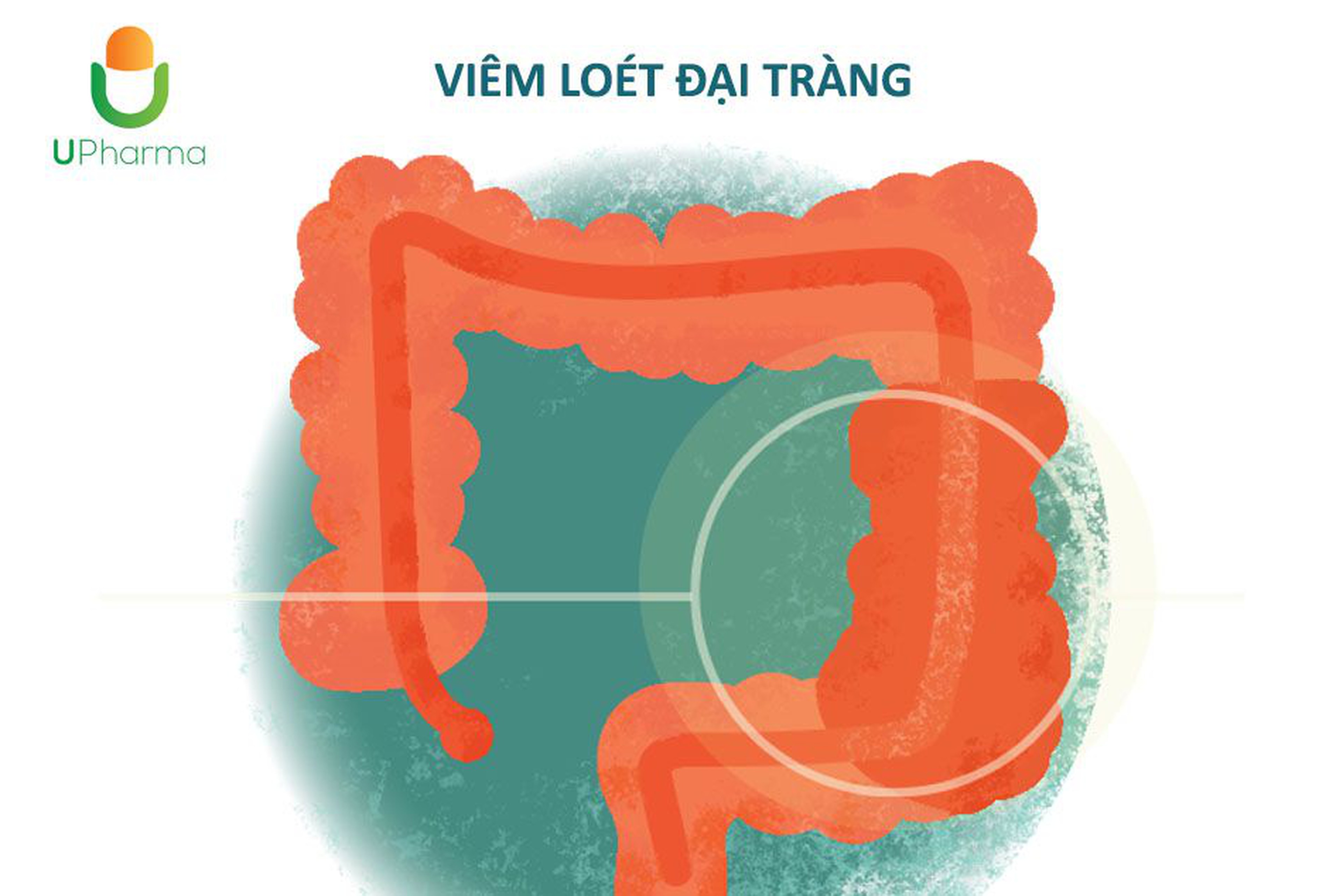 Viêm loét đại tràng: nguyên nhân, triệu chứng, cách điều trị bệnh.