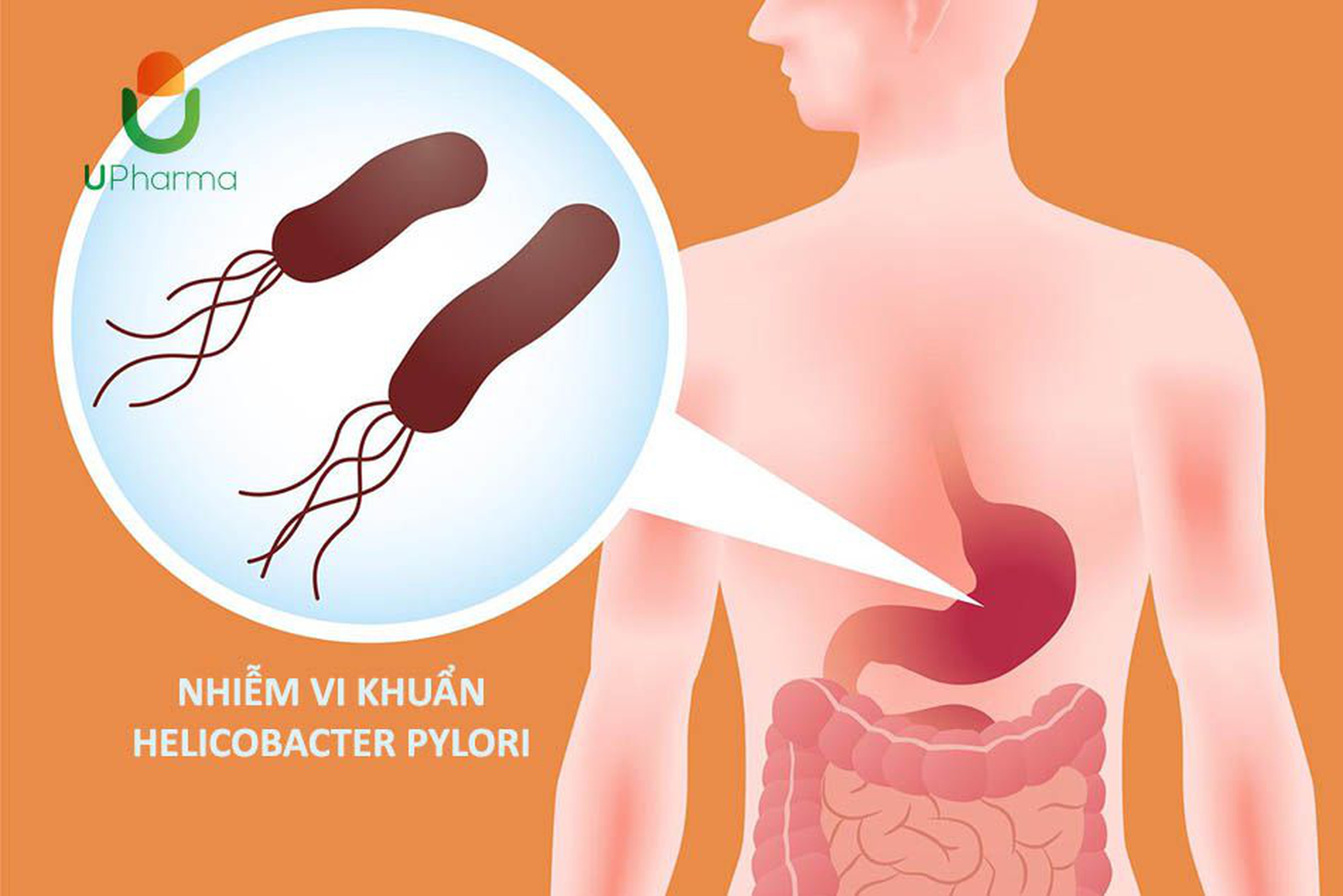 Nhiễm H.pylori: những điều cần biết, cách điều trị và phòng tránh
