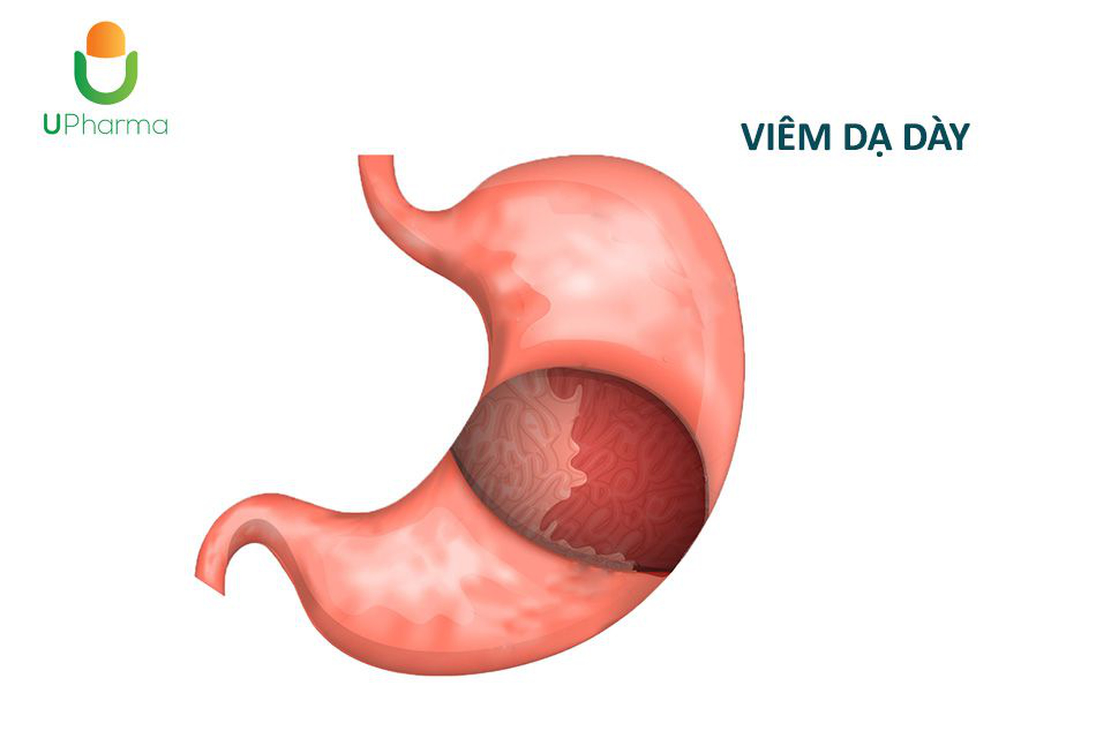 Viêm dạ dày: Những điều càn biết, biện pháp điều trị và phòng ngừa.