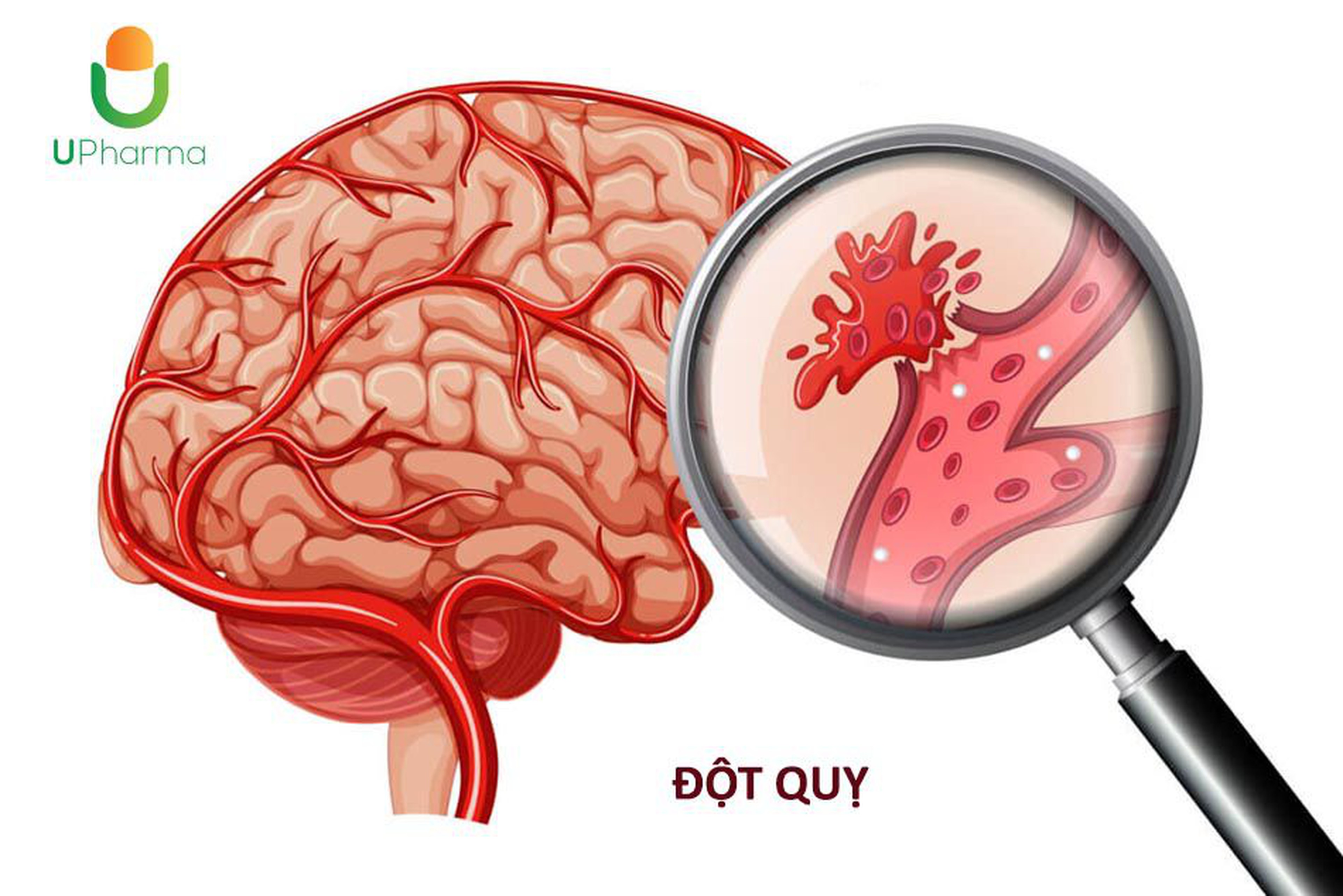 Đột quỵ: những điều cần biết và các biện pháp để giảm nguy cơ đột quỵ.