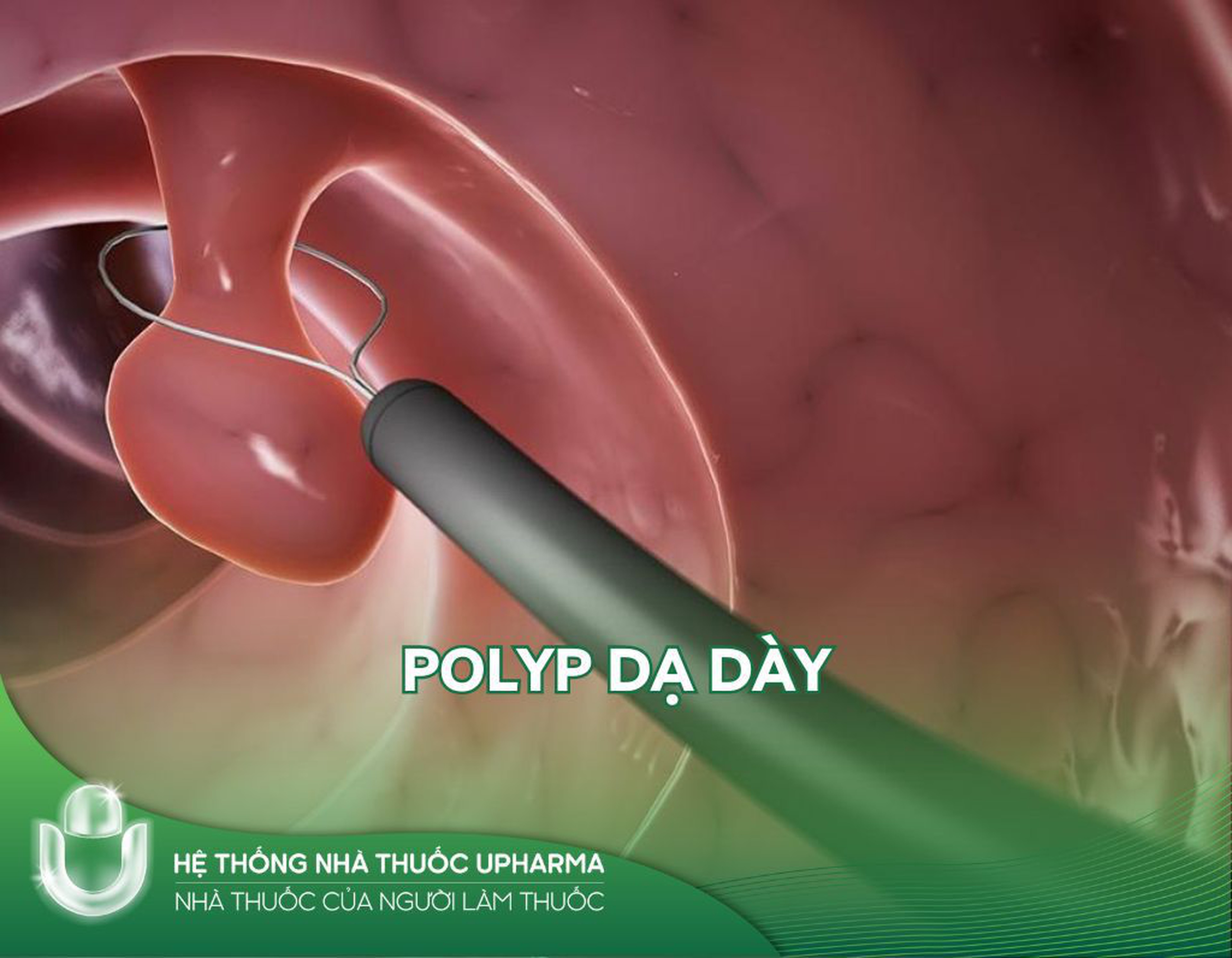 Polyp dạ dày: nguyên nhân gây bệnh và cách điều trị hiệu quả