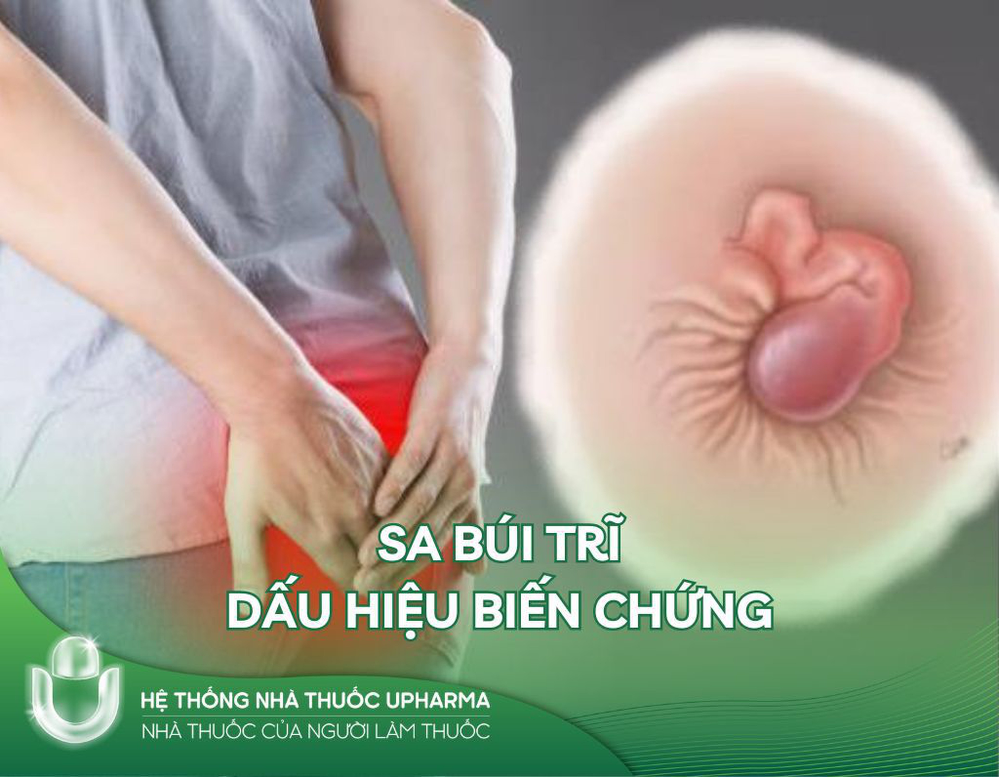 Sa búi trĩ là gì? Dấu hiệu và biến chứng của sa búi trĩ
