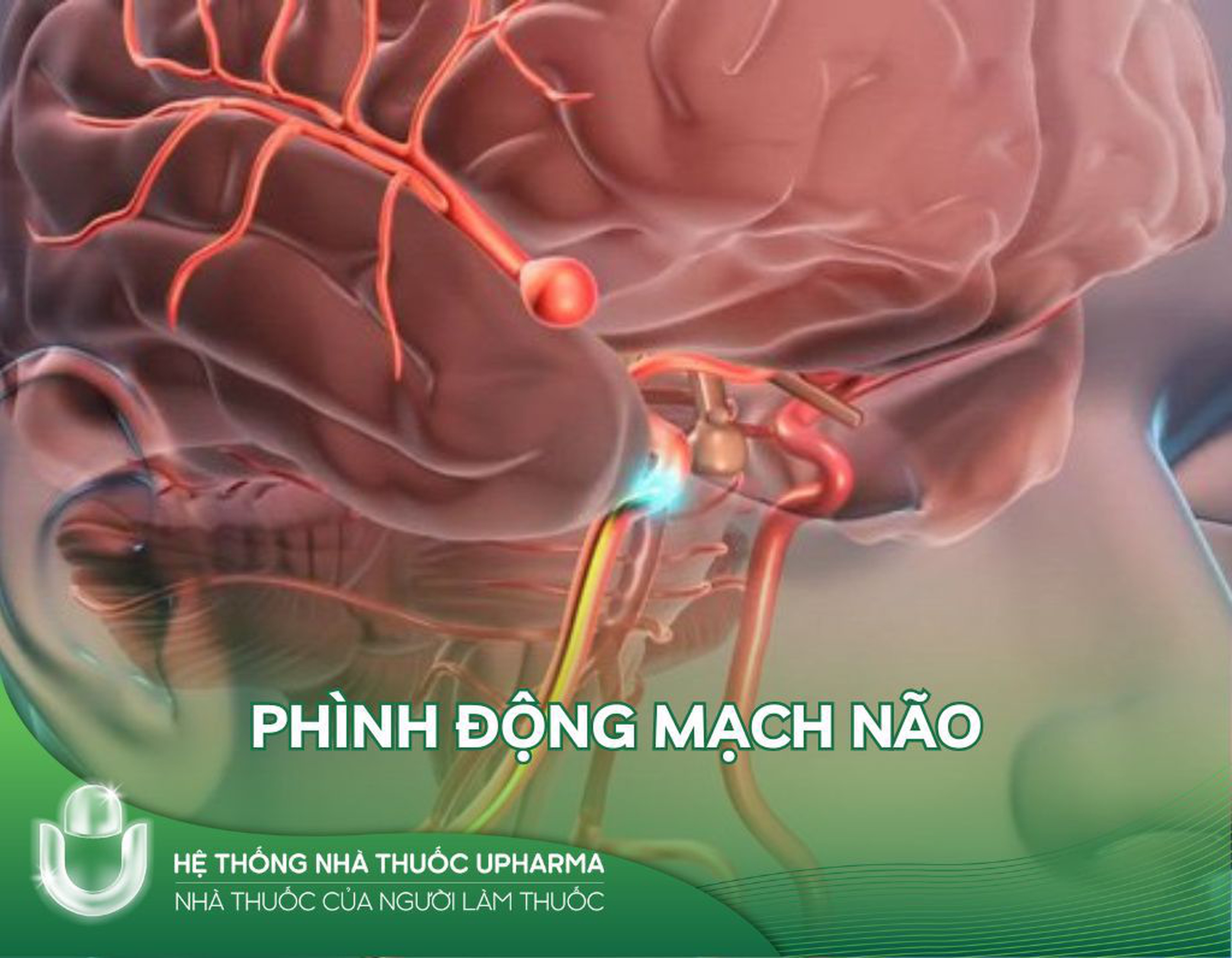 Phình động mạch não là gì? Phân loại phình động mạch não, nguyên nhân, triệu chứng và cách phòng bệnh