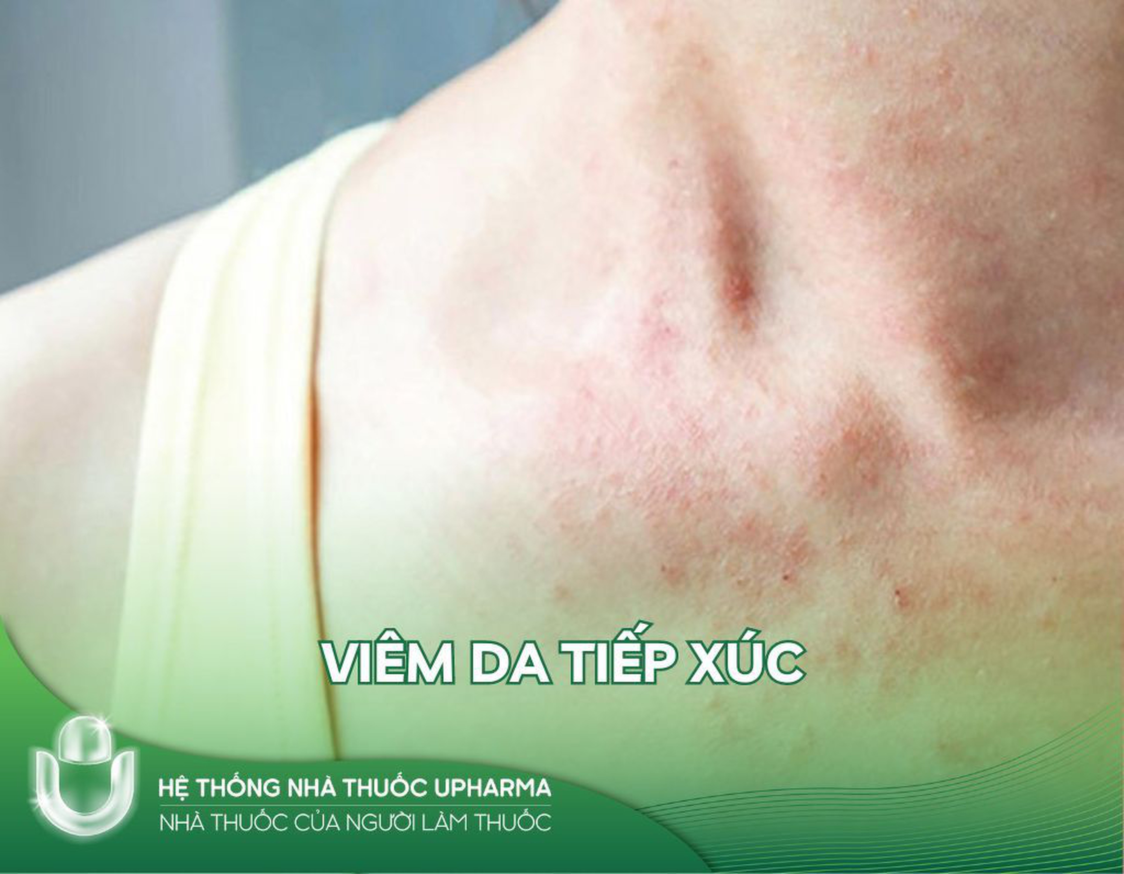 Viêm da tiếp xúc: Triệu chứng và cách điều trị