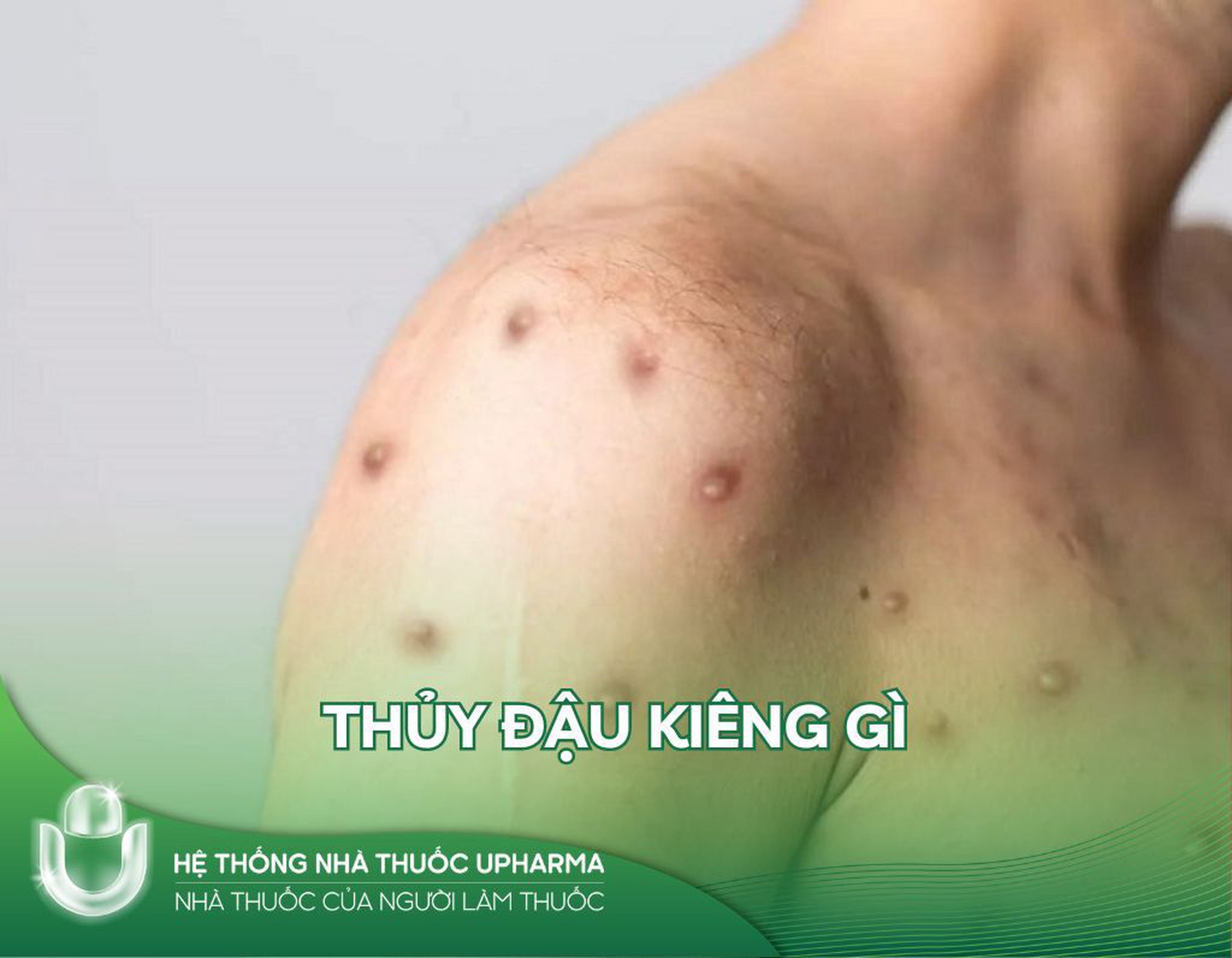 Thủy đậu kiêng gì? Thủy đậu có để lại sẹo không?