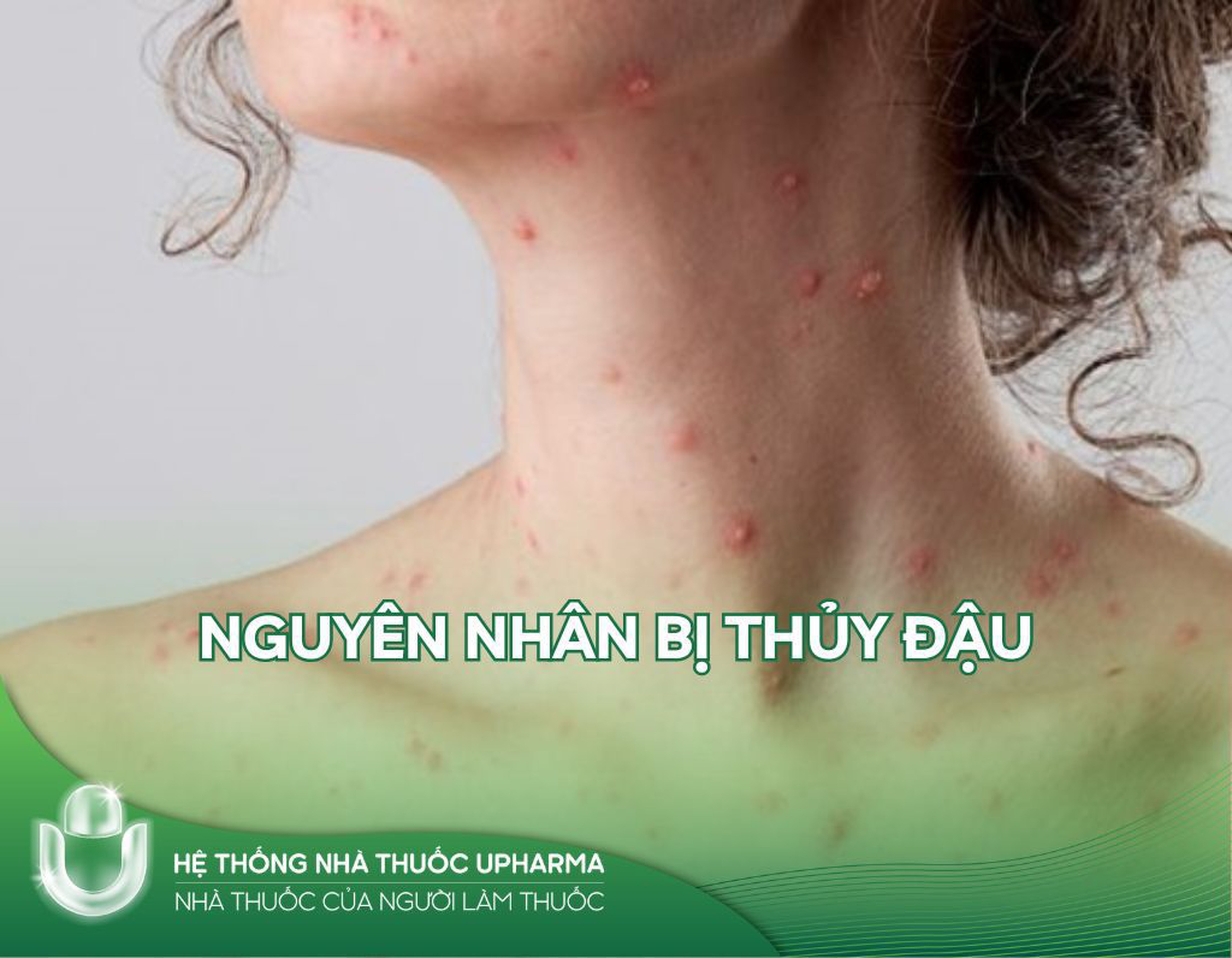 Nguyên nhân bị thủy đậu - Nhận biết và phòng tránh