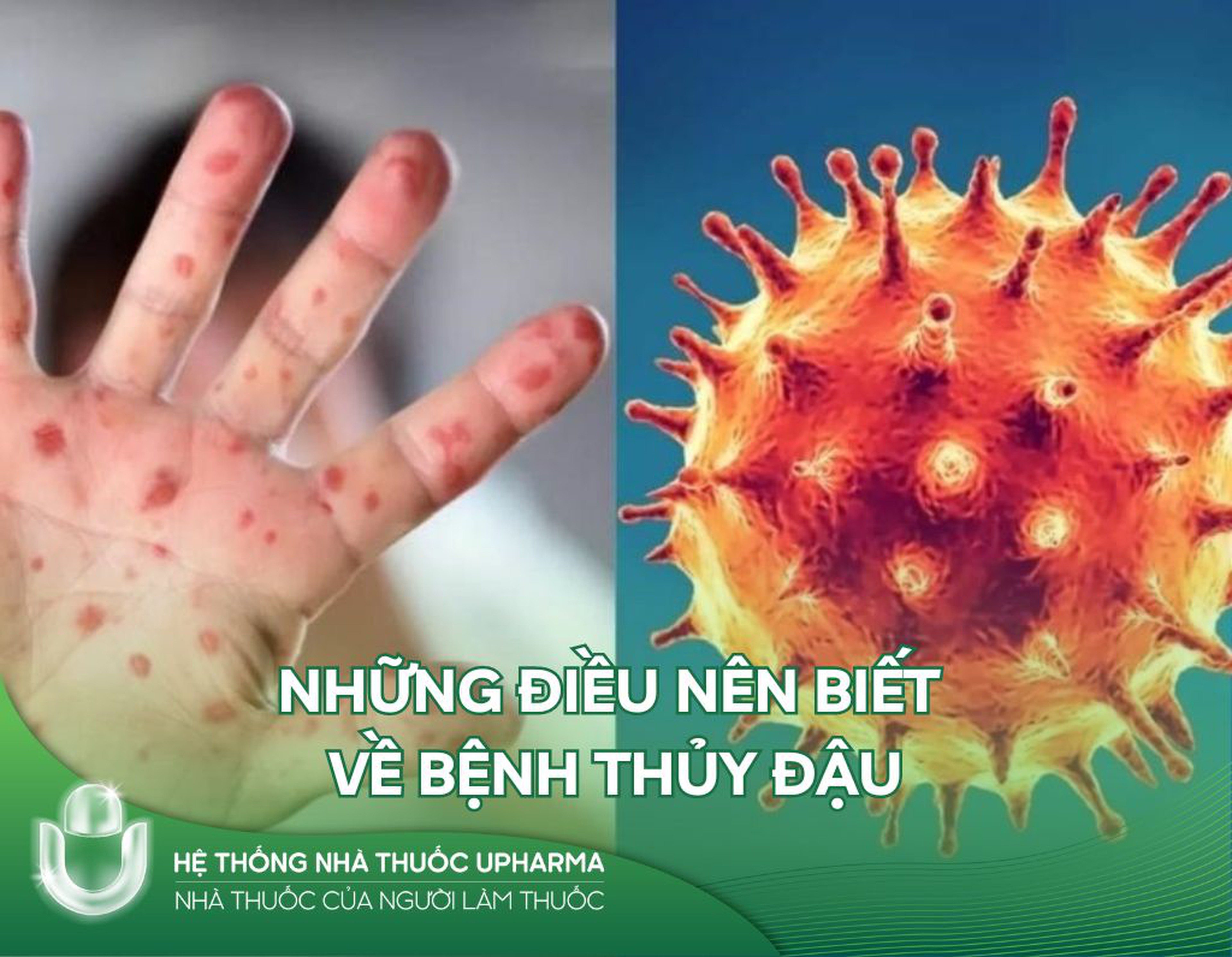 Tất tần tật những điều nên biết về bệnh thủy đậu 
