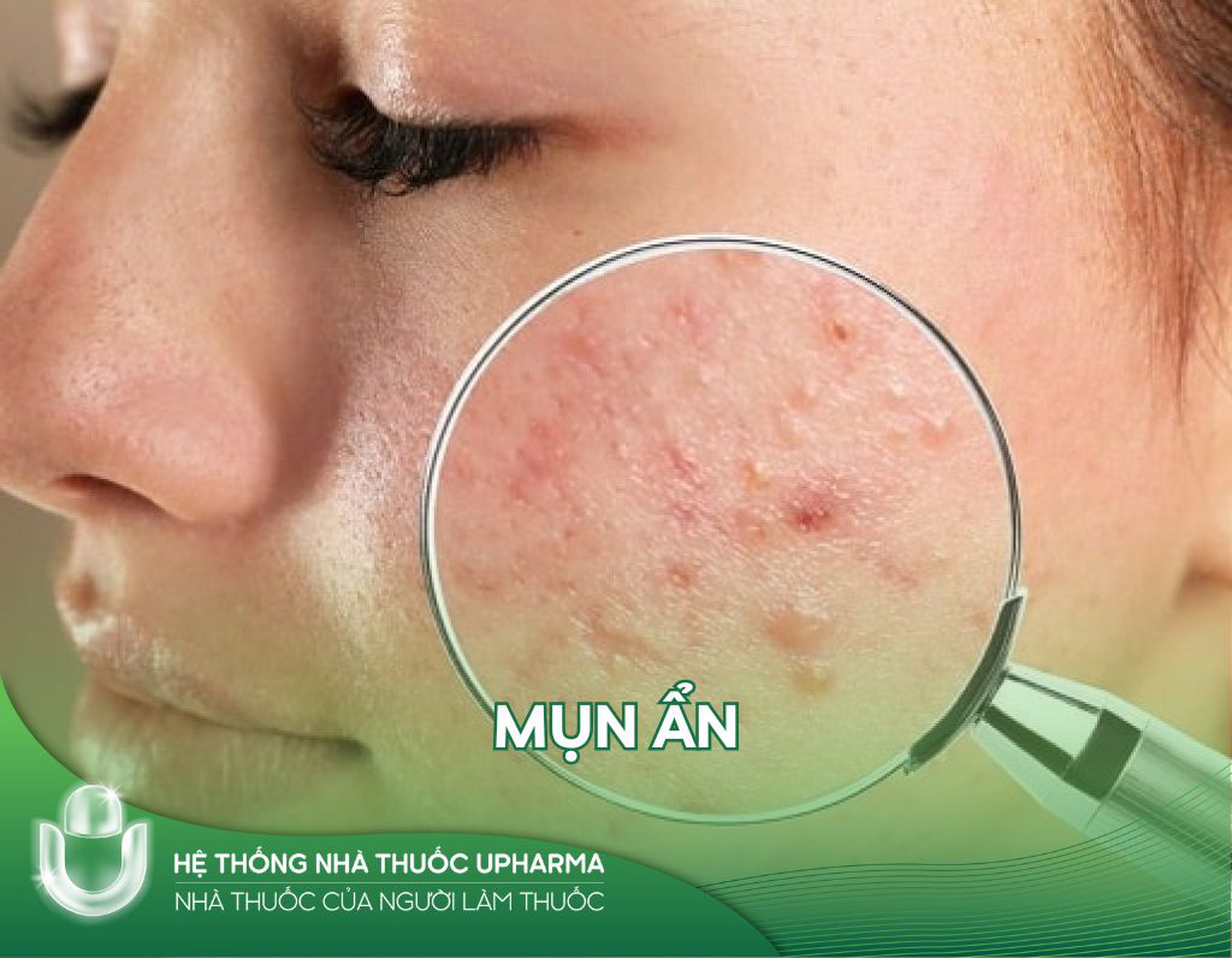 Mách nhỏ 7 cách trị mụn ẩn tại nhà mà chị em nên biết