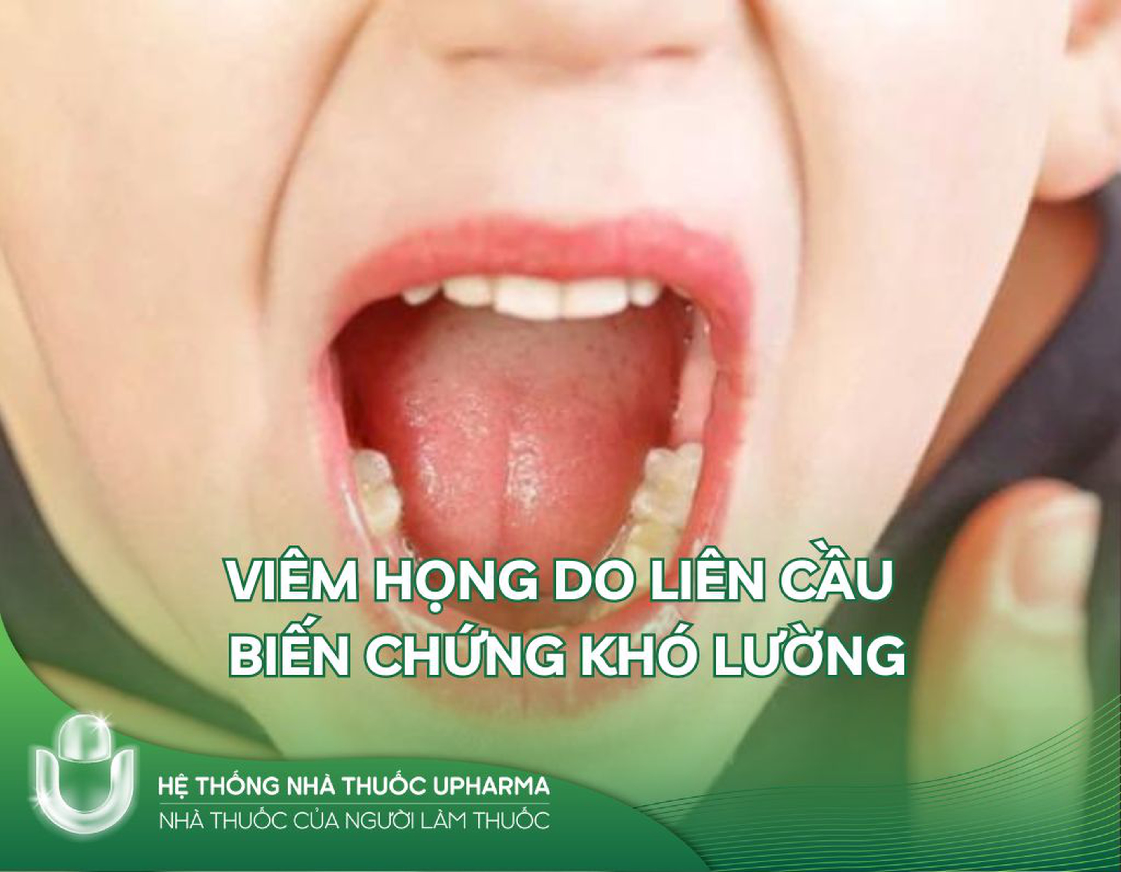 Viêm họng do liên cầu: Biến chứng khó lường