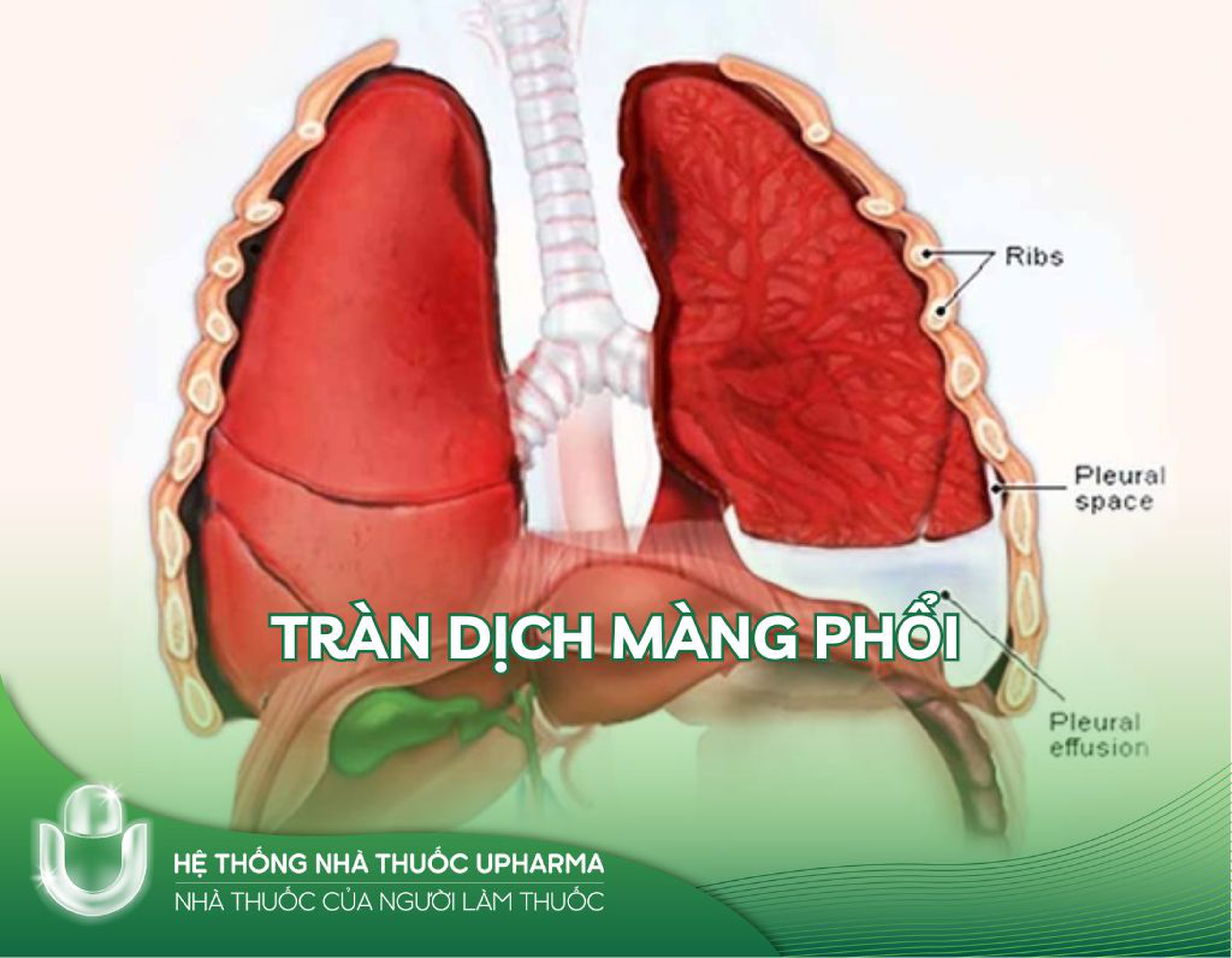 TRÀN DỊCH MÀNG PHỔI: NGUYÊN NHÂN, TRIỆU CHỨNG VÀ CÁCH ĐIỀU TRỊ