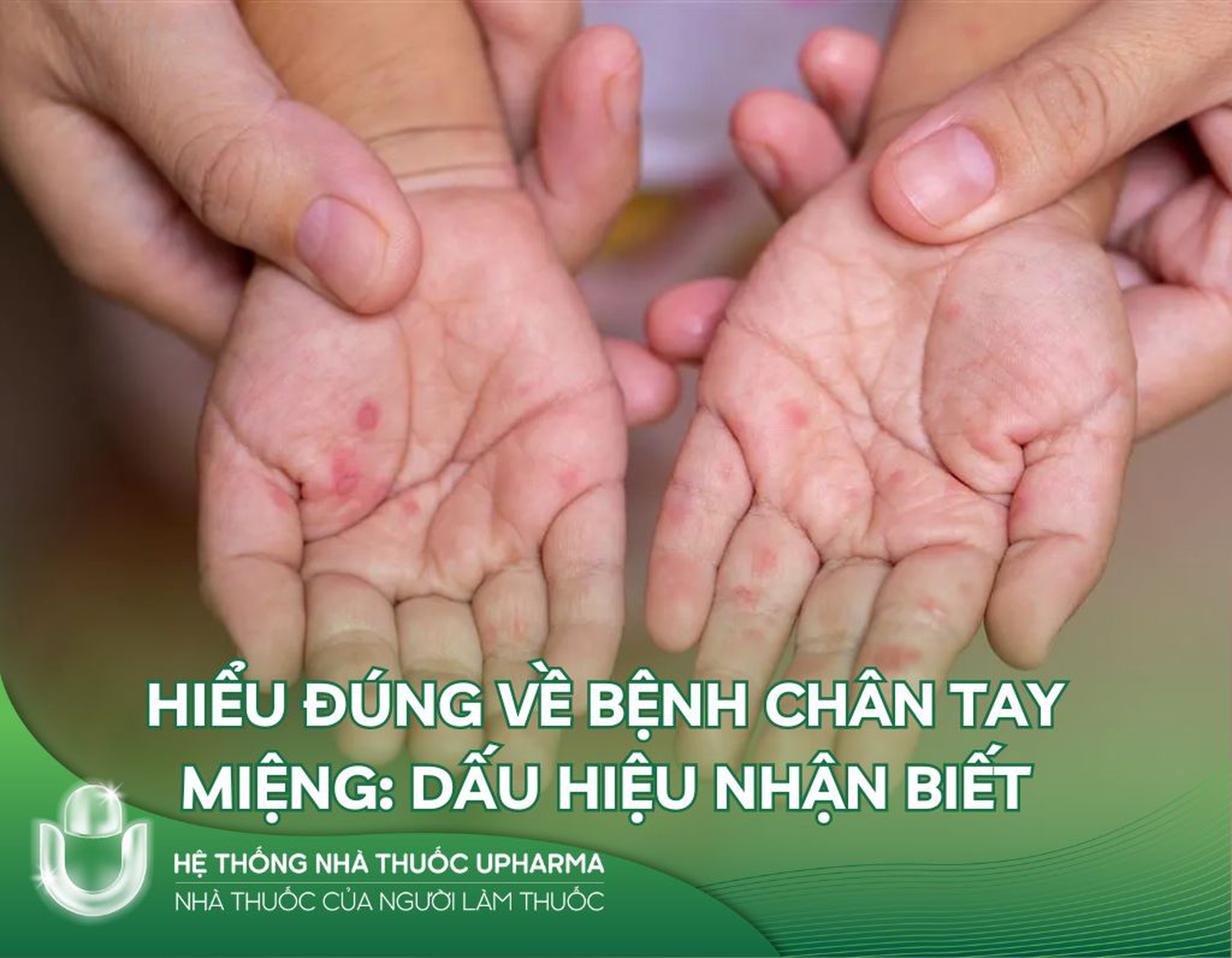 Hiểu đúng về bệnh tay chân miệng: Dấu hiệu nhận biết
