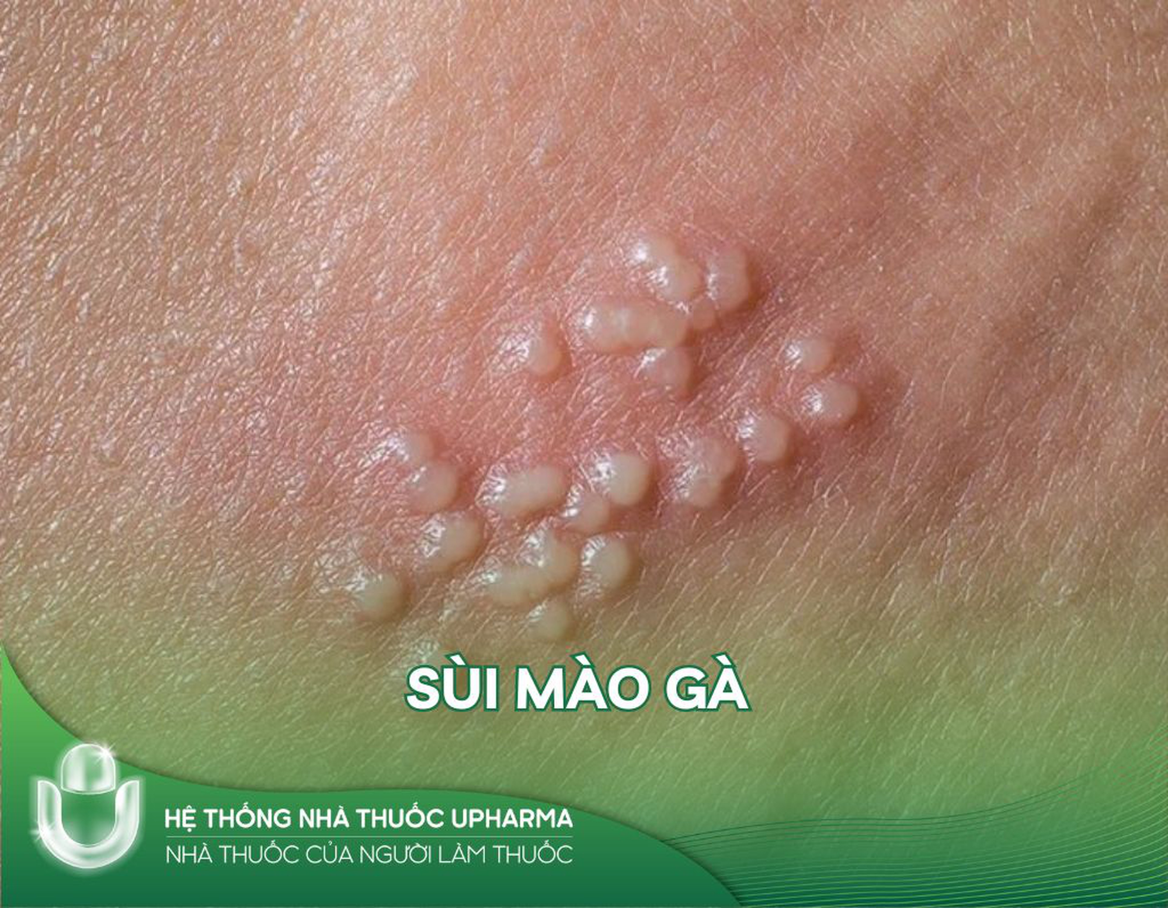 5 điều đáng sợ nhất về căn bệnh sùi mào gà
