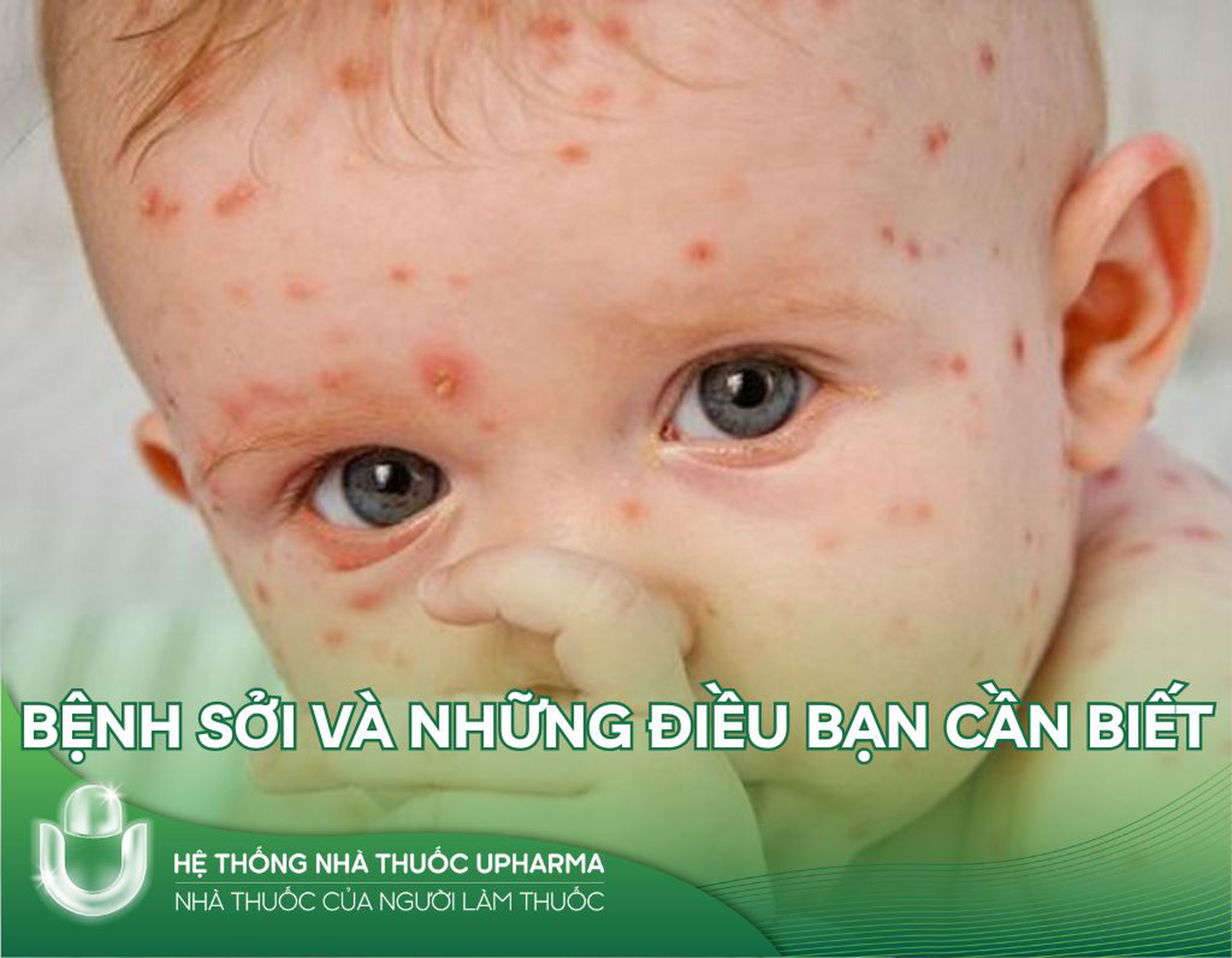 Bệnh sởi và những điều bạn cần biết