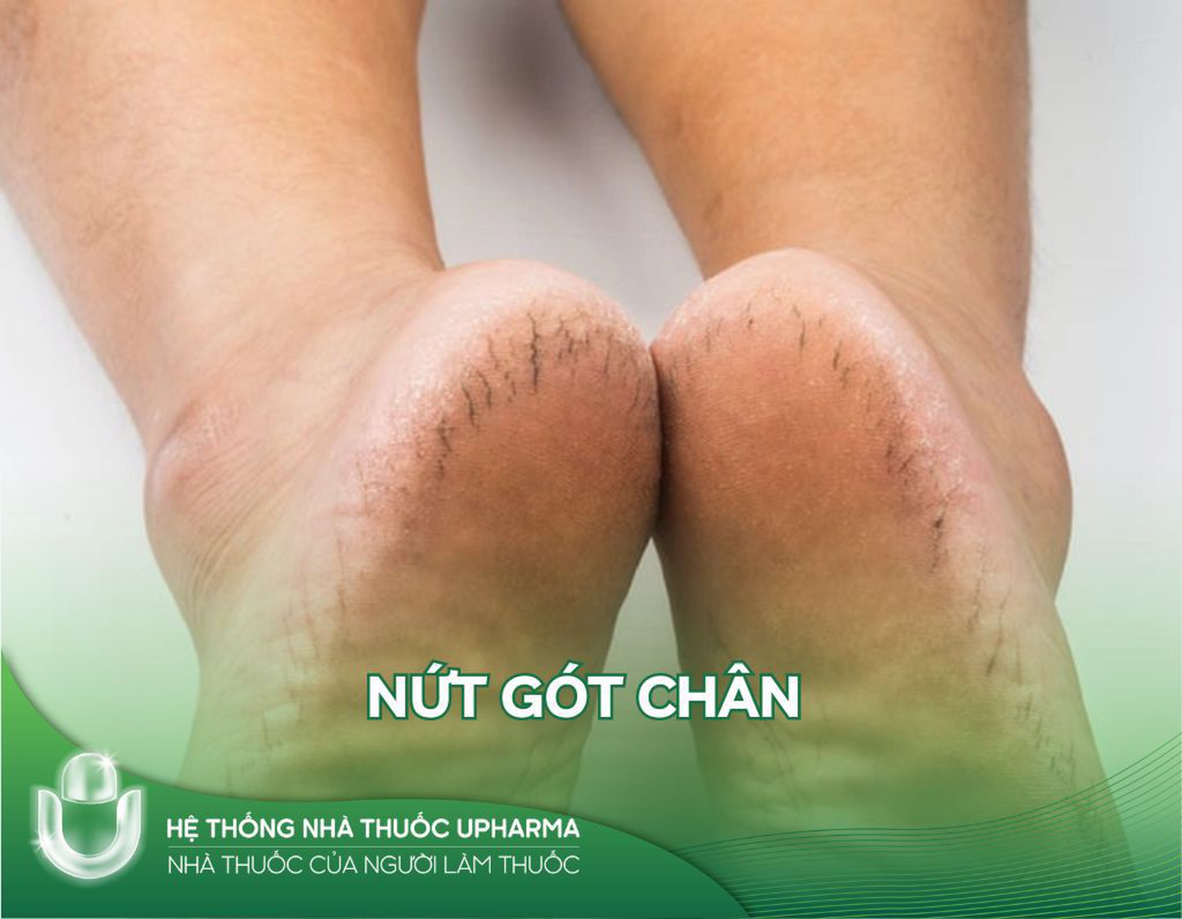 Nứt gót chân do đâu? Cách khắc phục hiệu quả