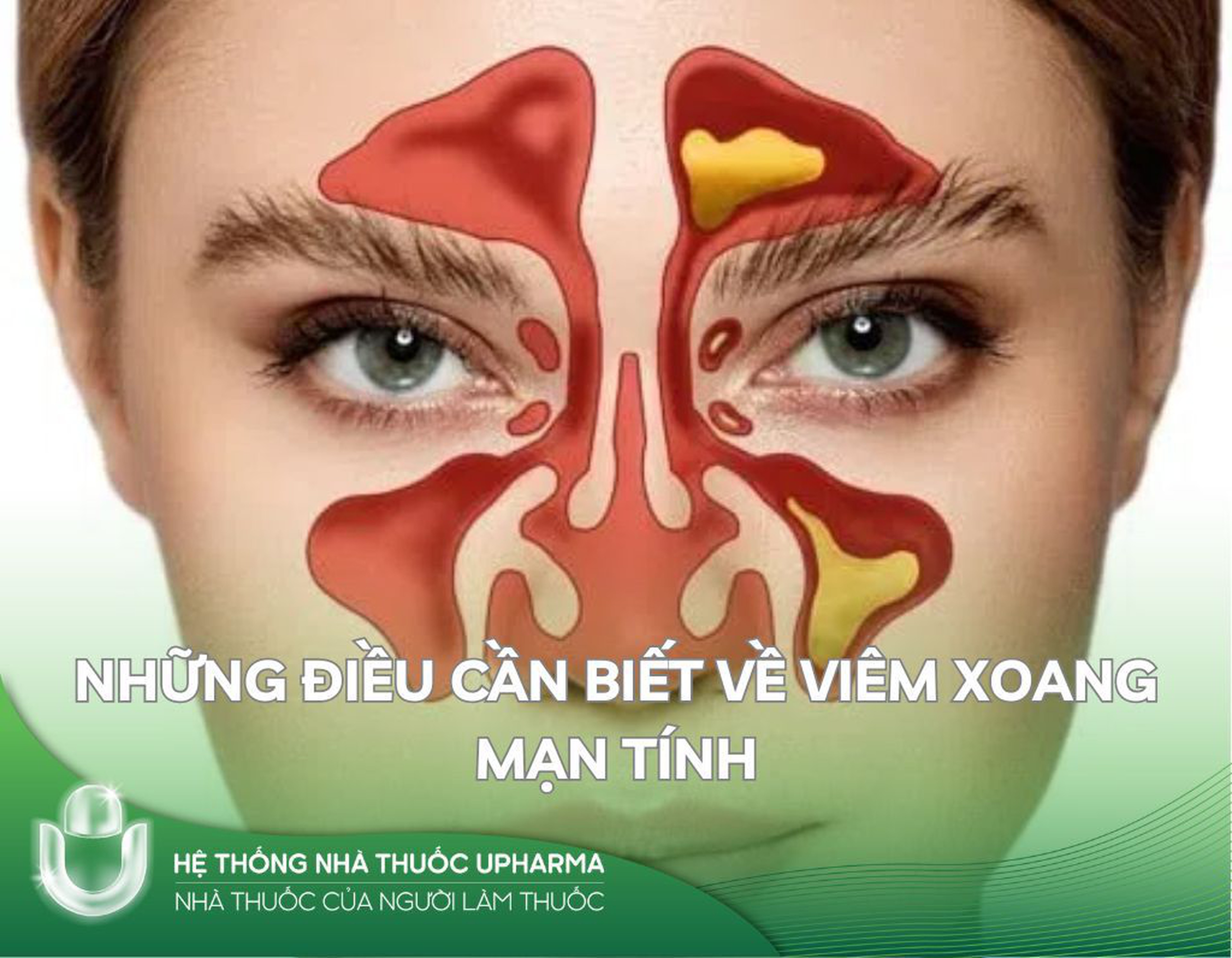 Những điều cần biết về viêm xoang mạn tính
