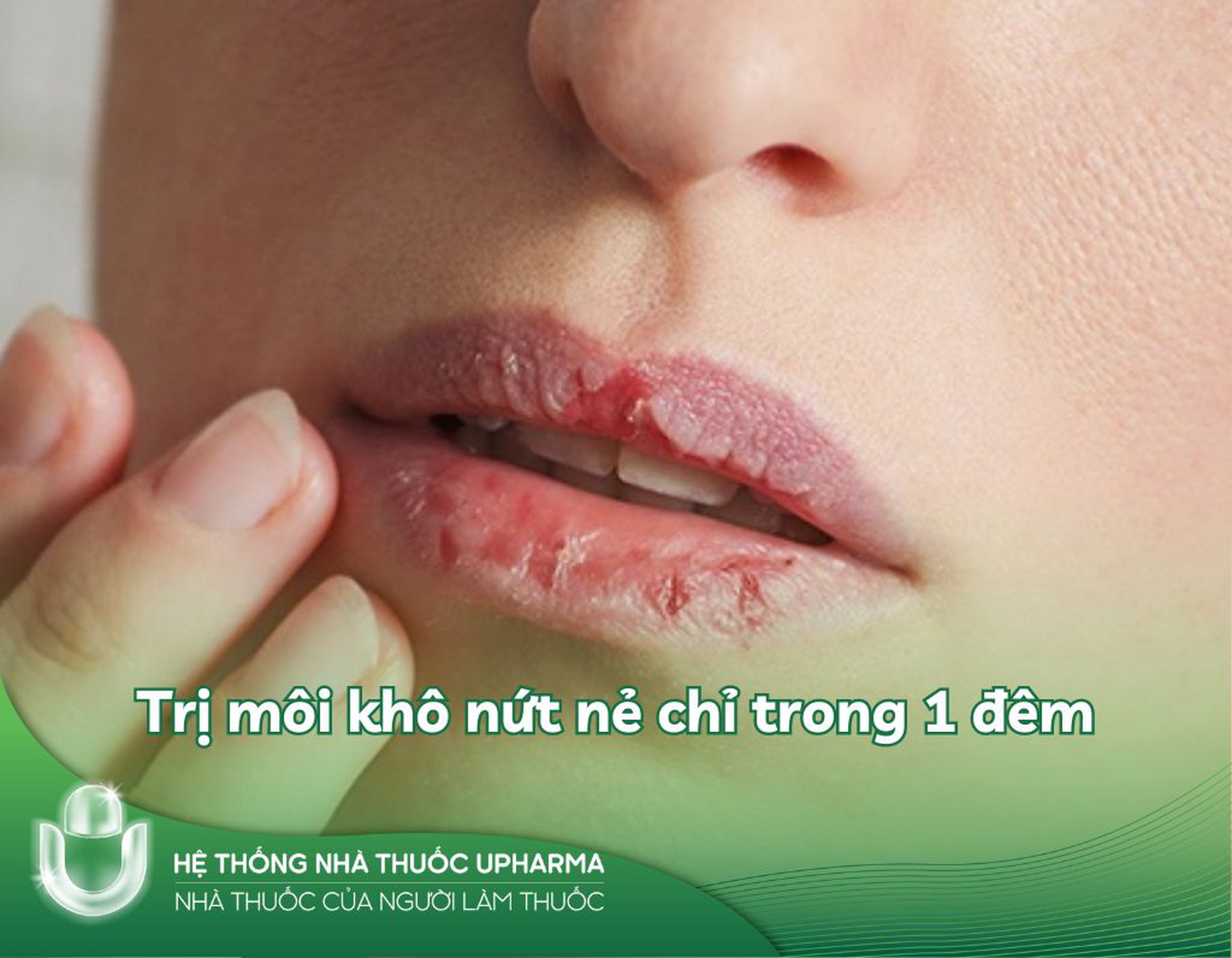 Trị môi khô nứt nẻ chỉ trong 1 đêm