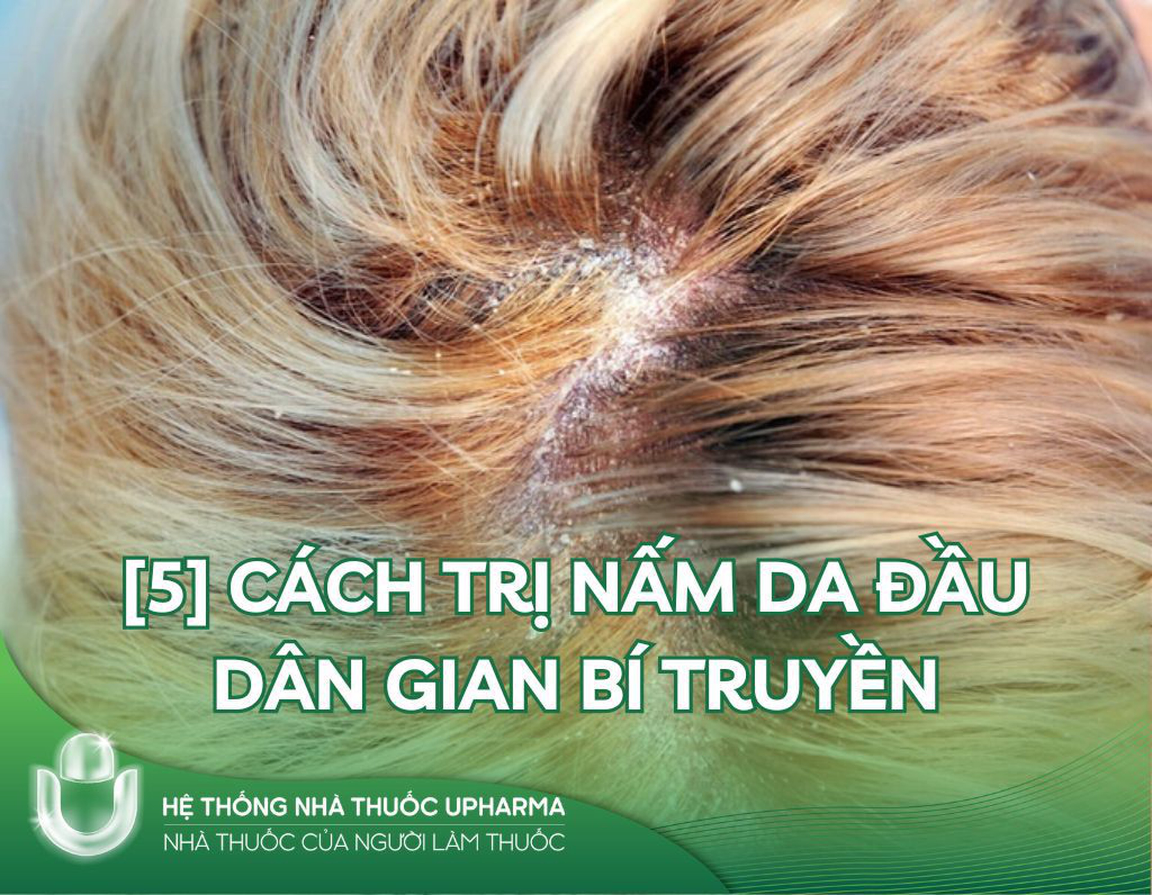  [5] cách trị nấm da đầu dân gian bí truyền