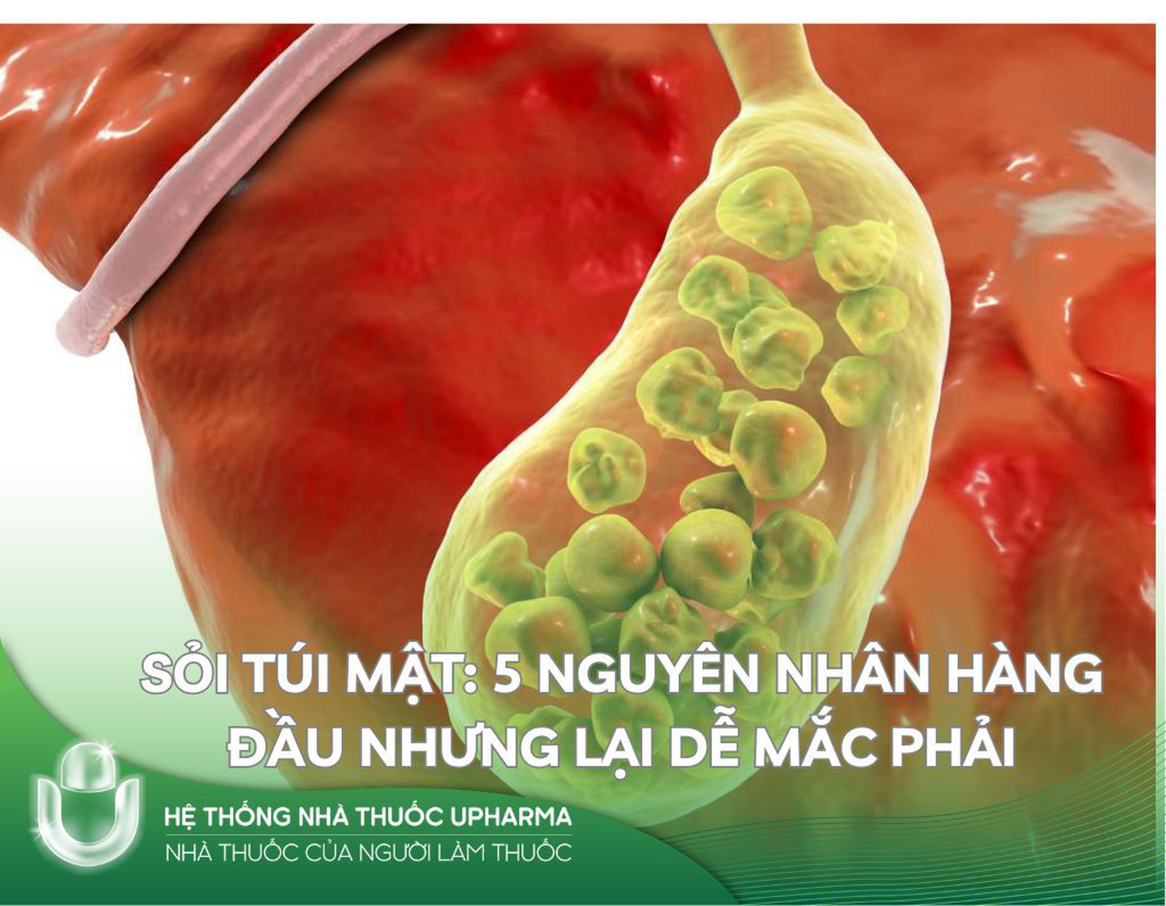 Sỏi túi mật: 5 nguyên nhân hàng đầu nhưng lại dễ mắc phải