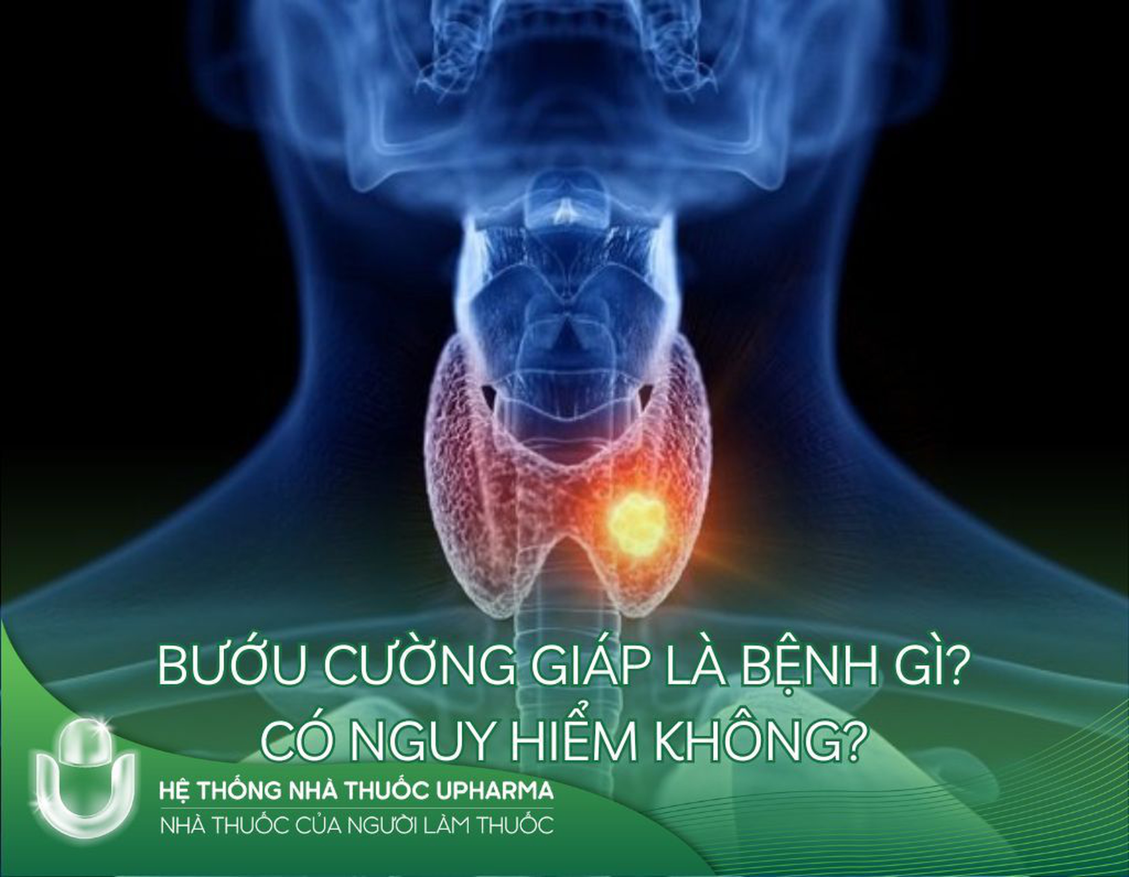 Bướu cường giáp là bệnh gì? Có nguy hiểm không?