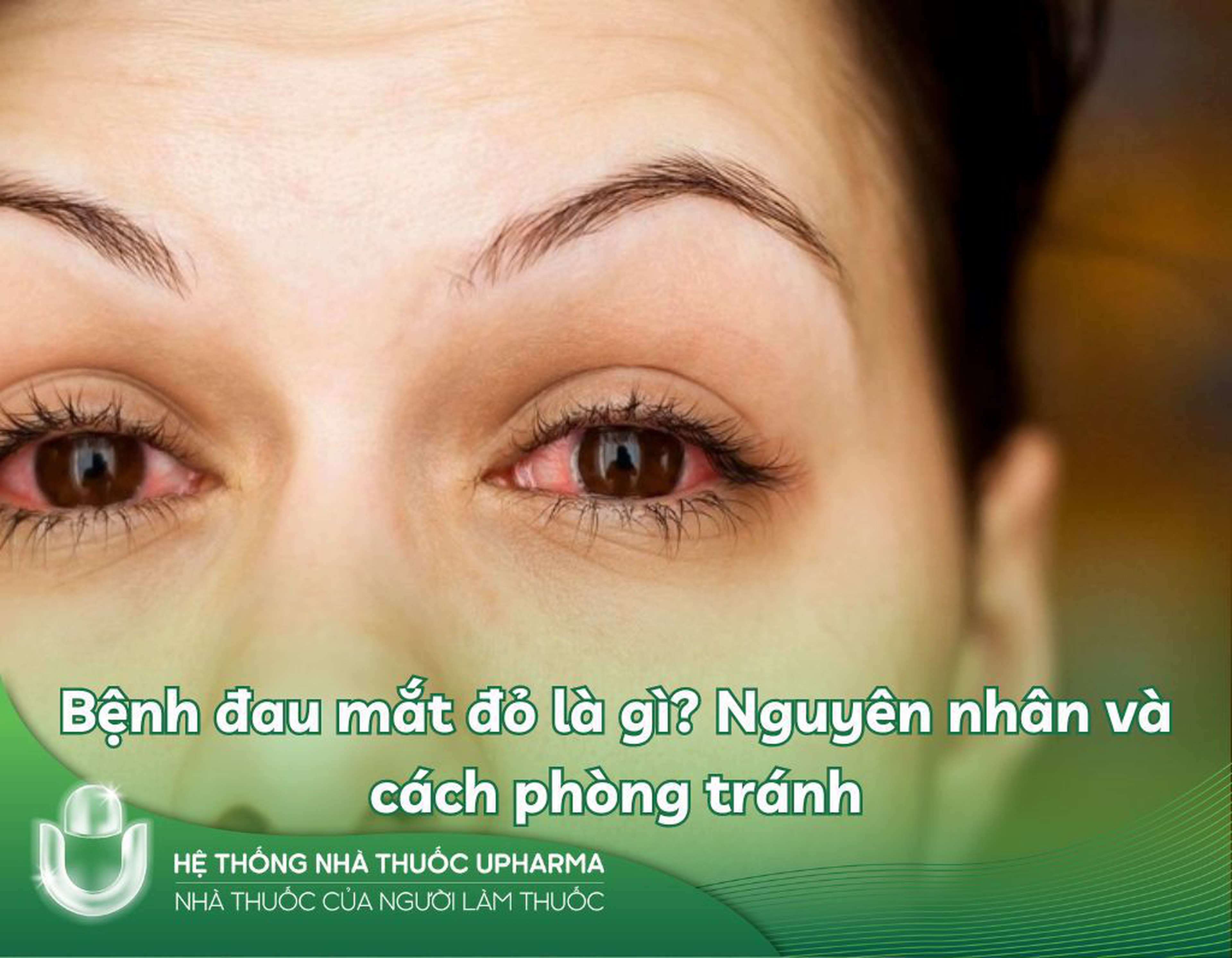Bệnh đau mắt đỏ là gì? Nguyên nhân và cách phòng tránh