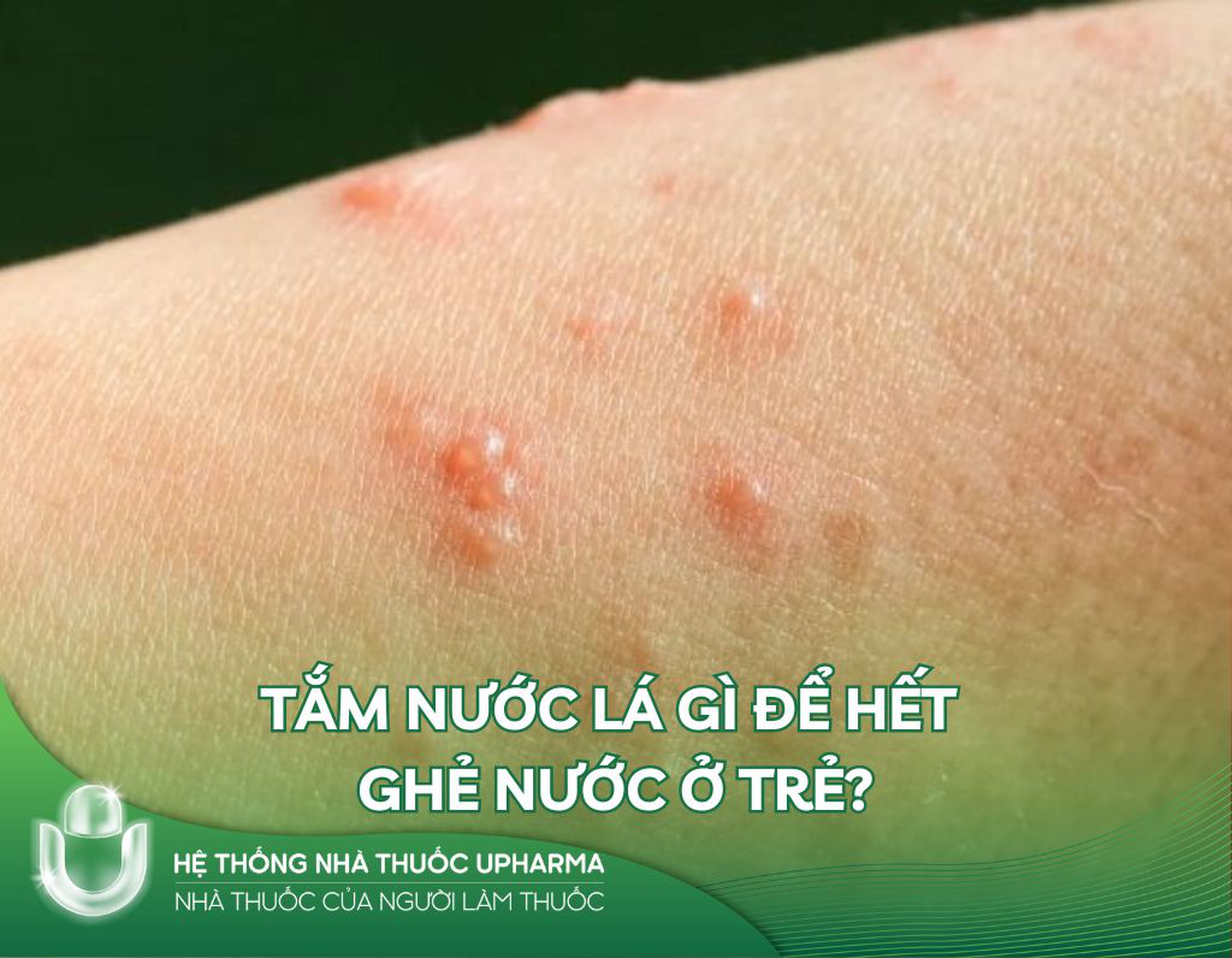 Tắm nước lá gì để hết ghẻ nước ở trẻ?