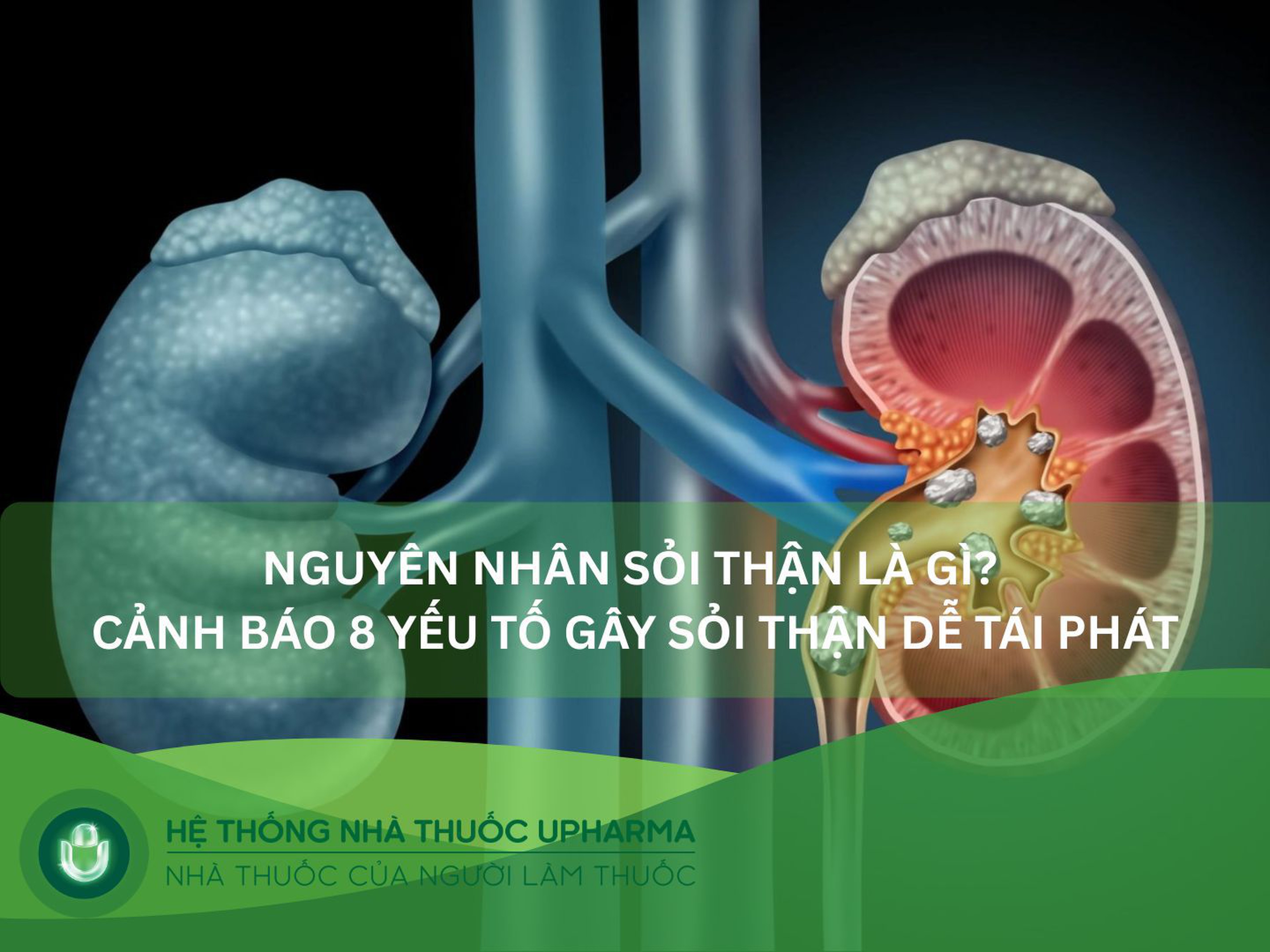 Nguyên nhân sỏi thận là gì? Cảnh báo 8 yếu tố gây sỏi thận dễ tái phát