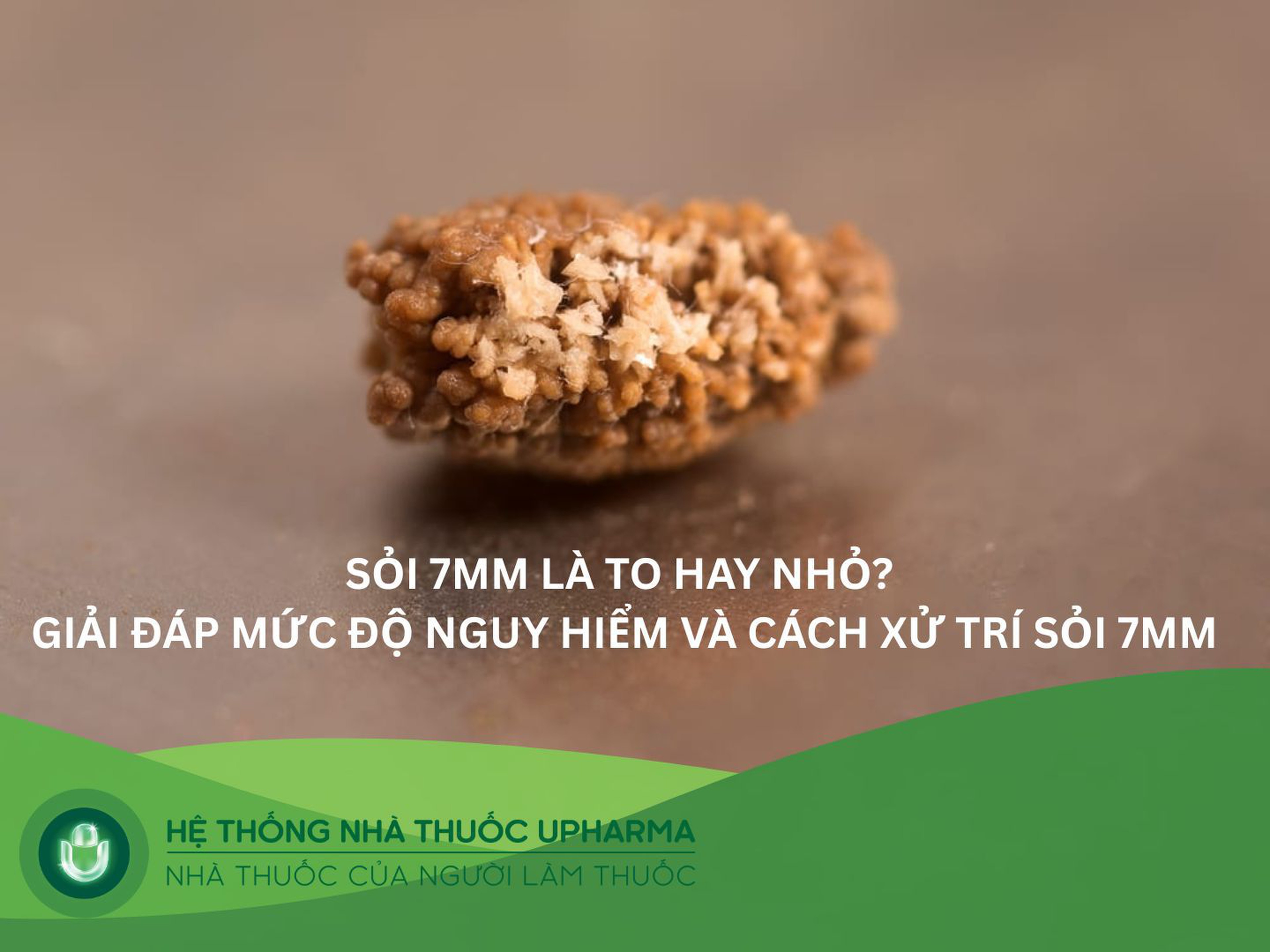 Sỏi 7mm là to hay nhỏ? Giải đáp mức độ nguy hiểm và cách xử trí sỏi 7mm