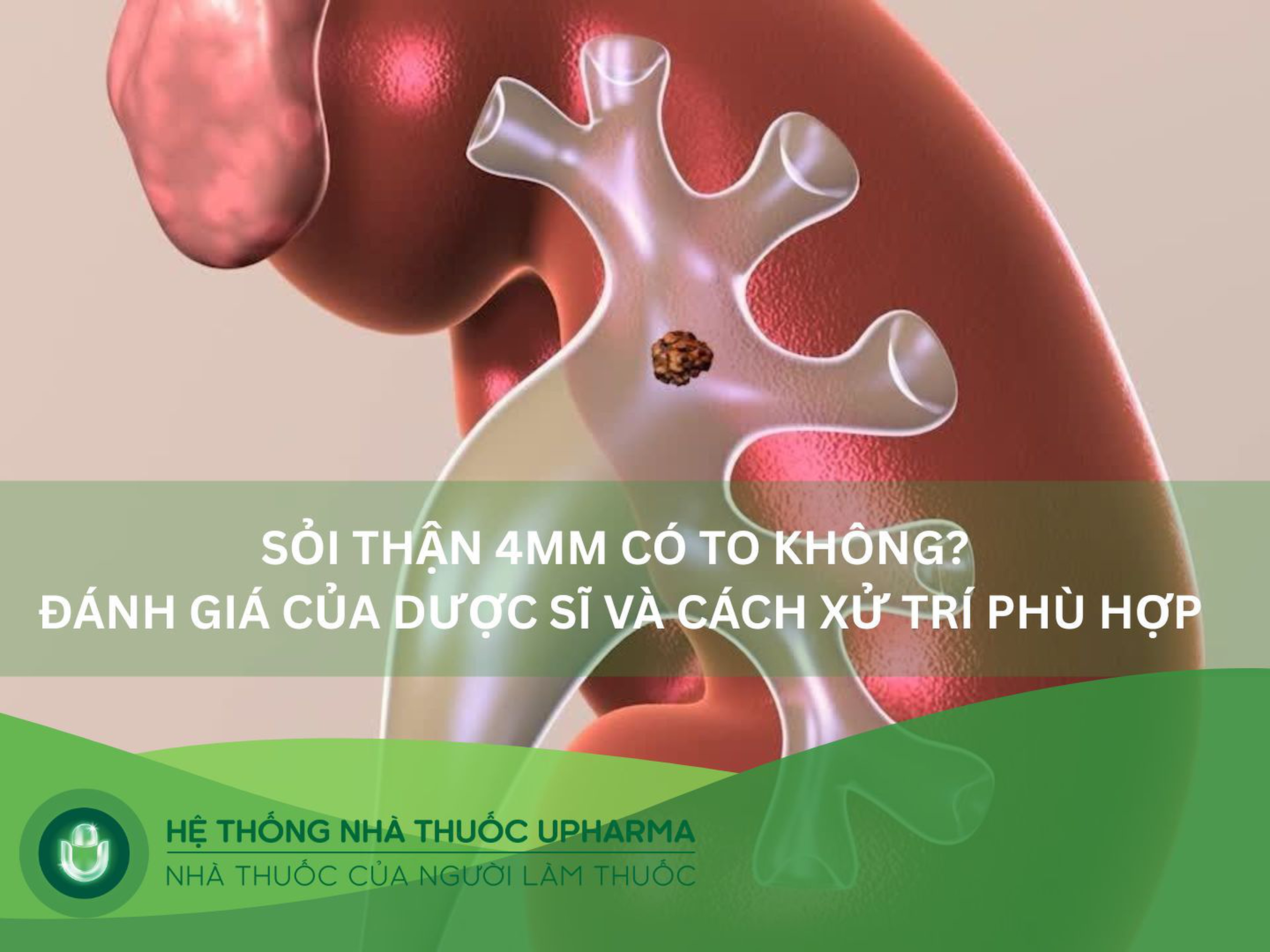 Sỏi thận 4mm có to không? Cách xử lý phù hợp