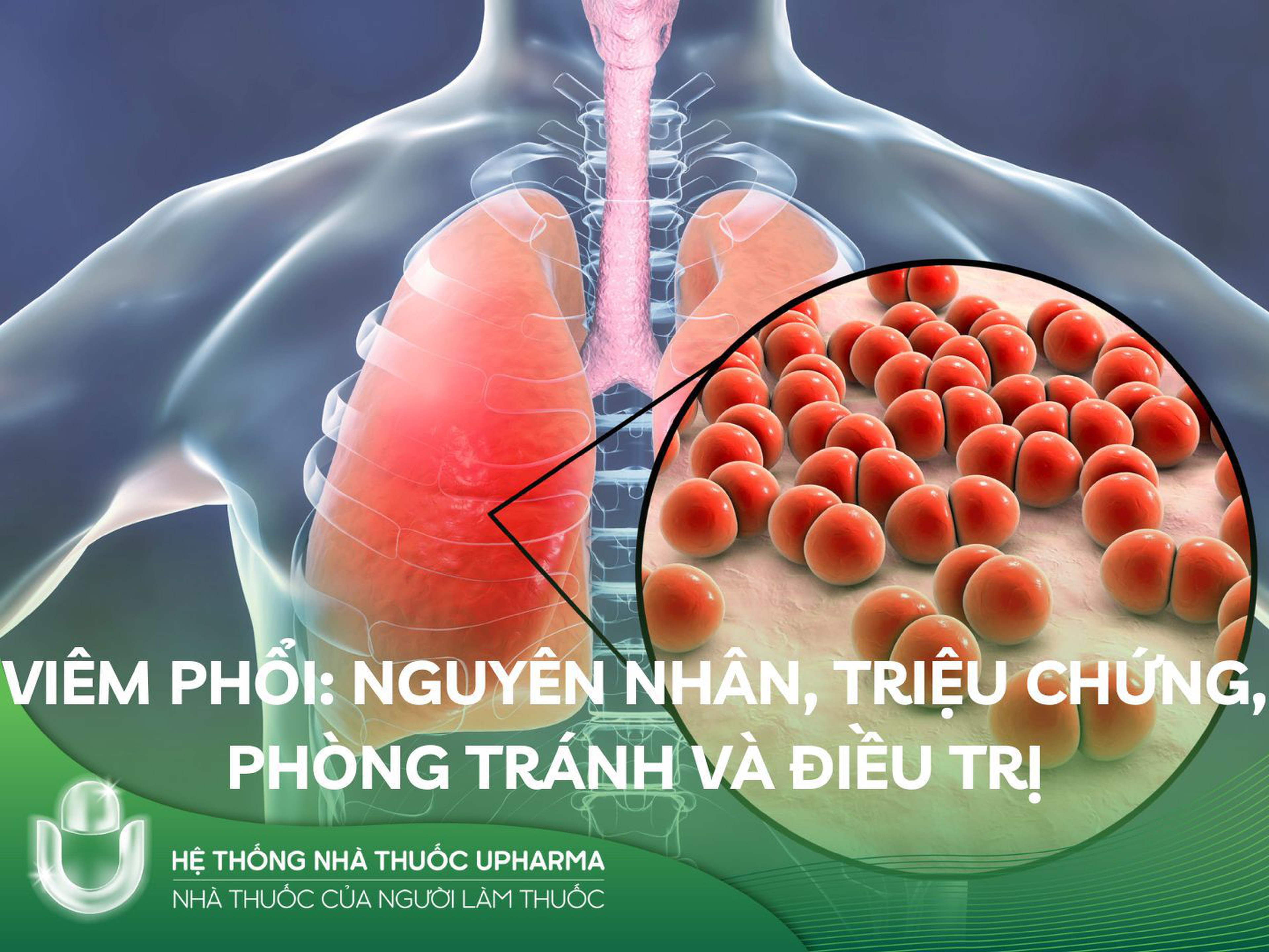 Viêm phổi: Nguyên nhân, triệu chứng, phòng tránh và điều trị