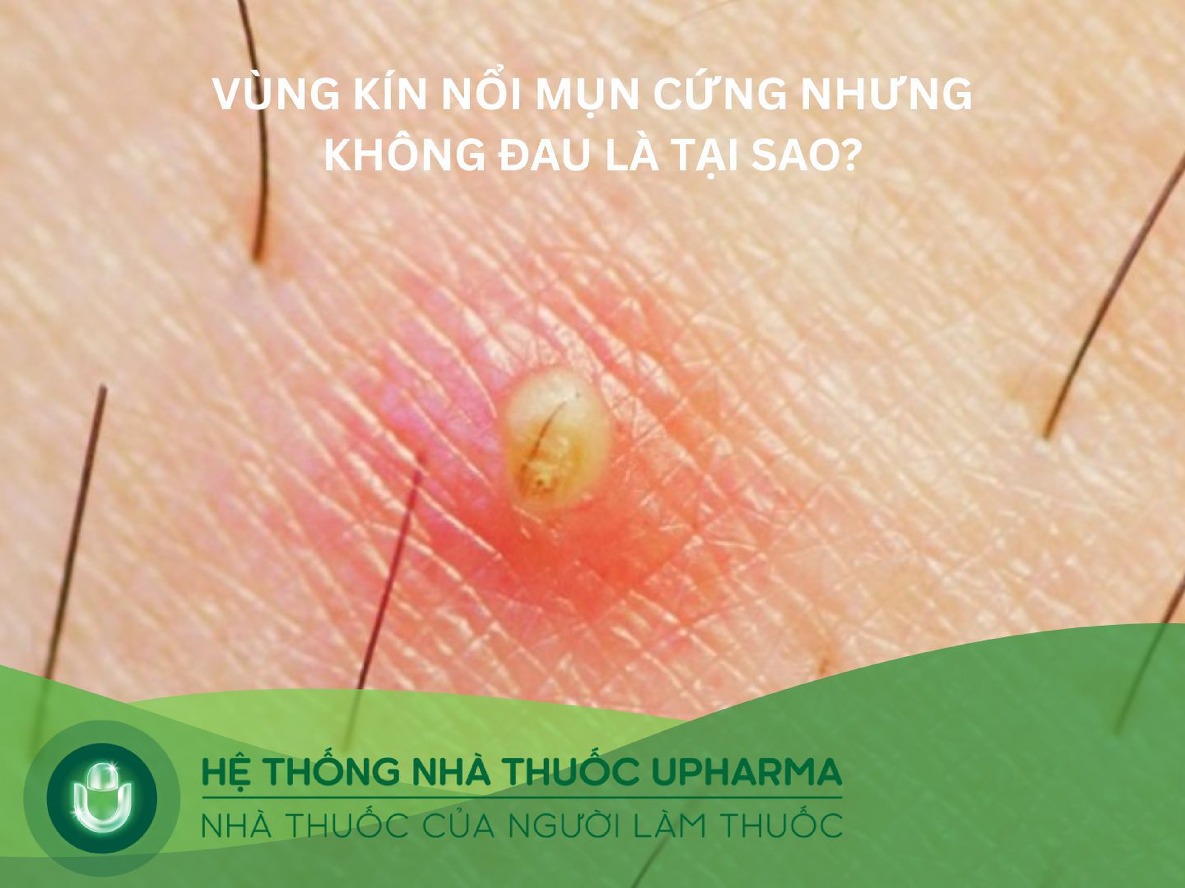 Vùng kín nổi mụn cứng nhưng không đau là tại sao?