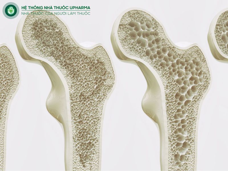 bệnh loãng xương