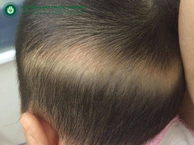 rụng tóc là dấu hiệu trẻ thiếu canxi