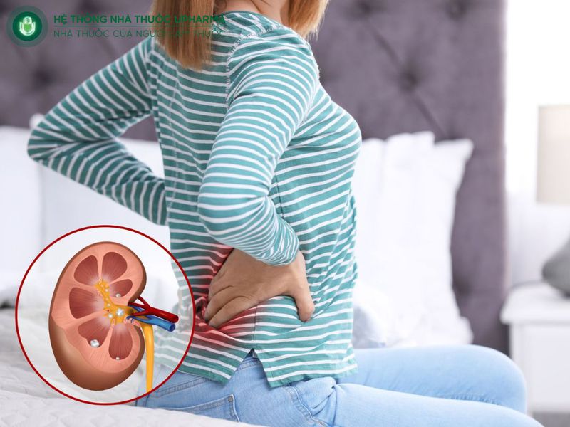 lưu ý khi điều trị sỏi thận 4mm