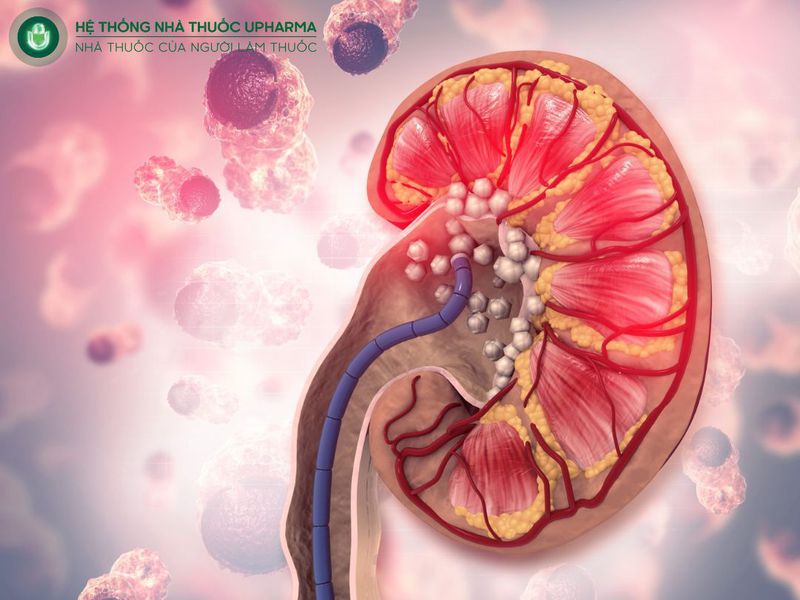 sỏi thận là gì