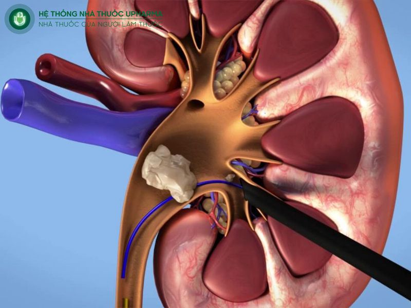 nội soi tán sỏi qua da