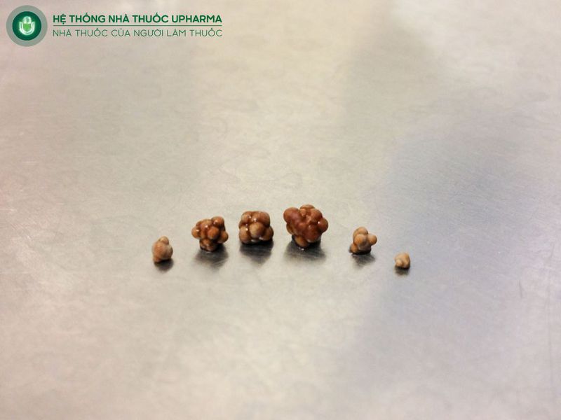 sỏi 7mm là to hay nhỏ