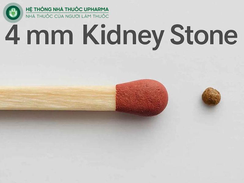 sỏi thận 4mm có to không