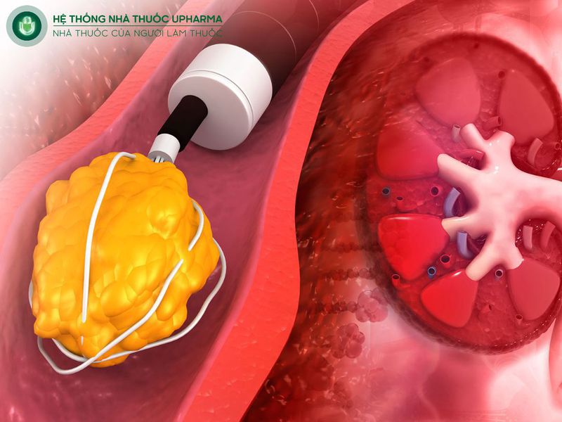 sỏi thận kích thước bao nhiêu thì phải mổ