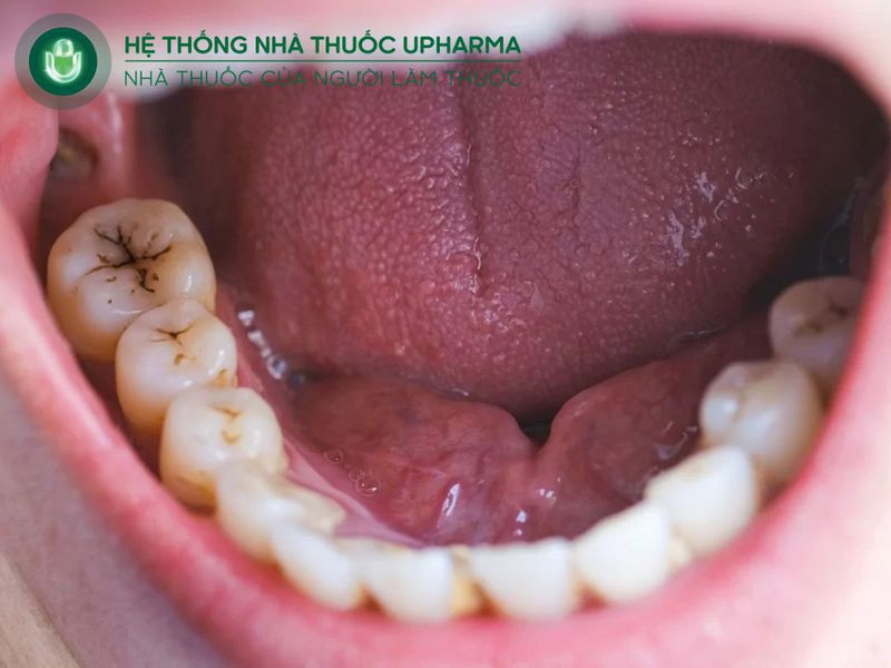 răng miệng có vấn đề là dấu hiệu thiếu canxi