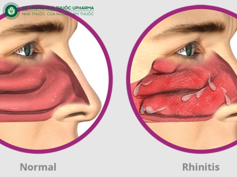 viêm mũi vận mạch